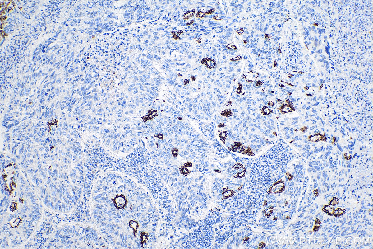 Immunohistochemistry (IHC) staining of human lung cancer tissue using Cytokeratin 7 Monoclonal antibody (68296-1-Ig)