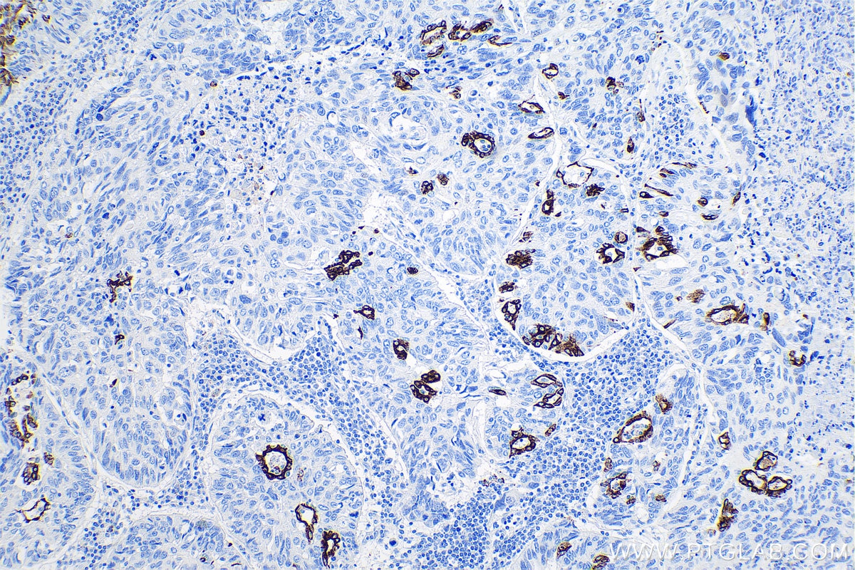 IHC staining of human lung cancer using 68296-1-Ig