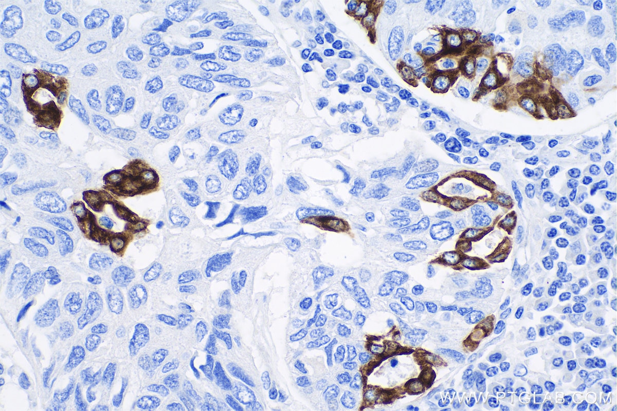 Immunohistochemistry (IHC) staining of human lung cancer tissue using Cytokeratin 7 Monoclonal antibody (68296-1-Ig)