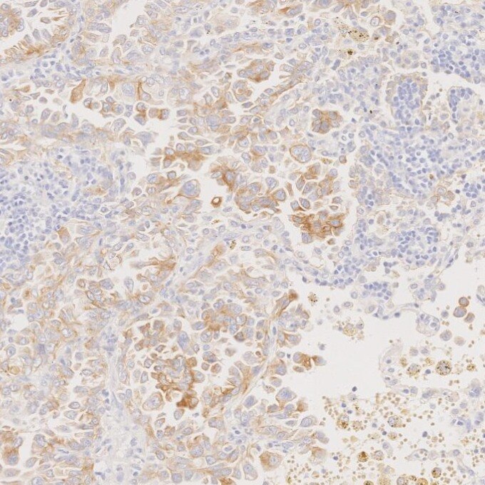 Immunohistochemistry (IHC) staining of human lung cancer tissue using Cytokeratin 7 Monoclonal antibody (68296-1-Ig)