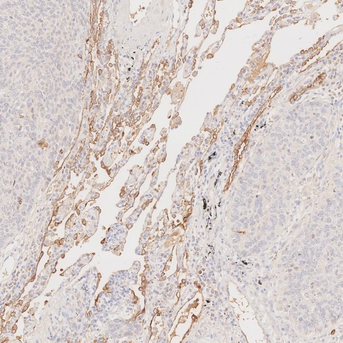 Immunohistochemistry (IHC) staining of human lung cancer tissue using Cytokeratin 7 Monoclonal antibody (68296-1-Ig)