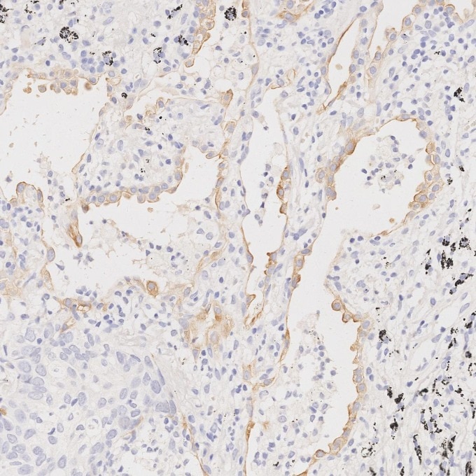 Immunohistochemistry (IHC) staining of human lung cancer tissue using Cytokeratin 7 Monoclonal antibody (68296-1-Ig)