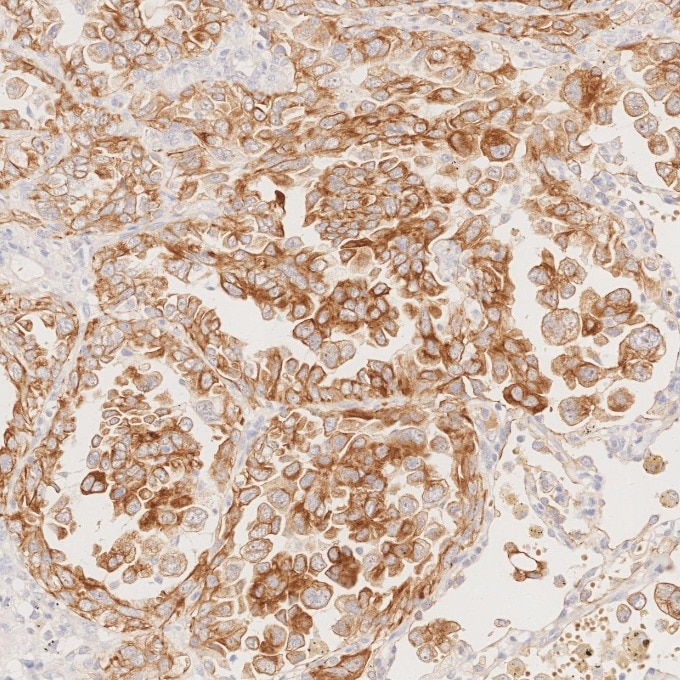 Immunohistochemistry (IHC) staining of human lung cancer tissue using Cytokeratin 7 Monoclonal antibody (68296-1-Ig)