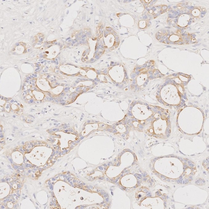 Immunohistochemistry (IHC) staining of human pancreas cancer tissue using Cytokeratin 7 Monoclonal antibody (68296-1-Ig)