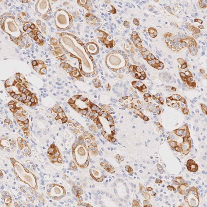 Immunohistochemistry (IHC) staining of human renal cell carcinoma tissue using Cytokeratin 7 Monoclonal antibody (68296-1-Ig)