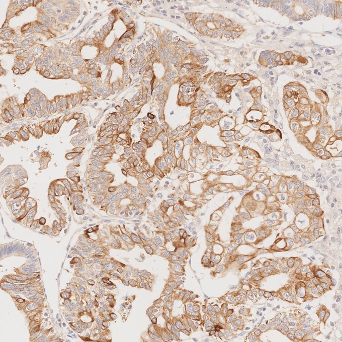 Immunohistochemistry (IHC) staining of human pancreas cancer tissue using Cytokeratin 7 Monoclonal antibody (68296-1-Ig)