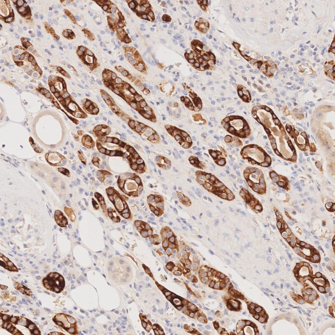 Immunohistochemistry (IHC) staining of human renal cell carcinoma tissue using Cytokeratin 7 Monoclonal antibody (68296-1-Ig)