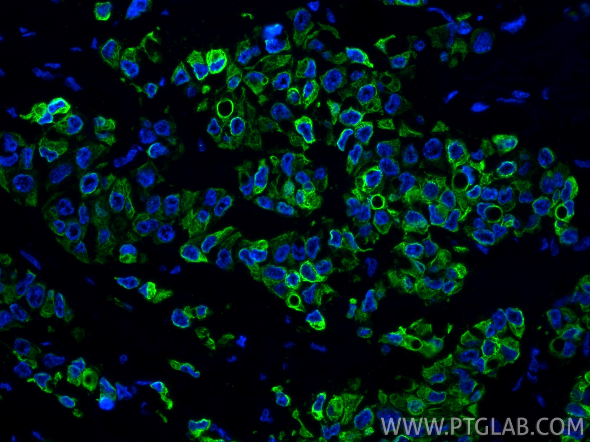 Immunofluorescence (IF) / fluorescent staining of human breast cancer tissue using Cytokeratin 7 Recombinant monoclonal antibody (86153-7-RR)