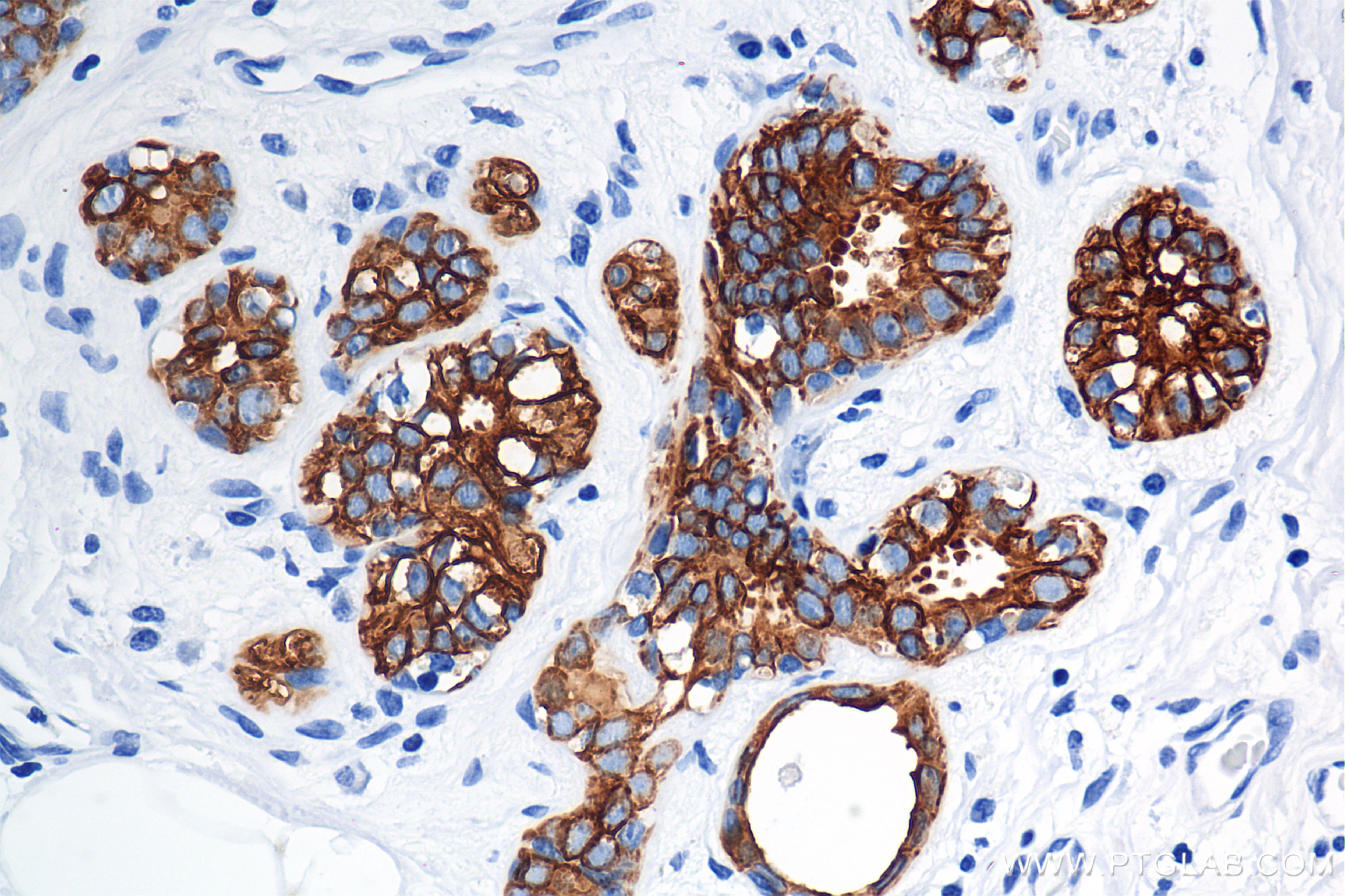 Immunohistochemistry (IHC) staining of human breast cancer tissue using Cytokeratin 7 Recombinant antibody (86153-7-RR)