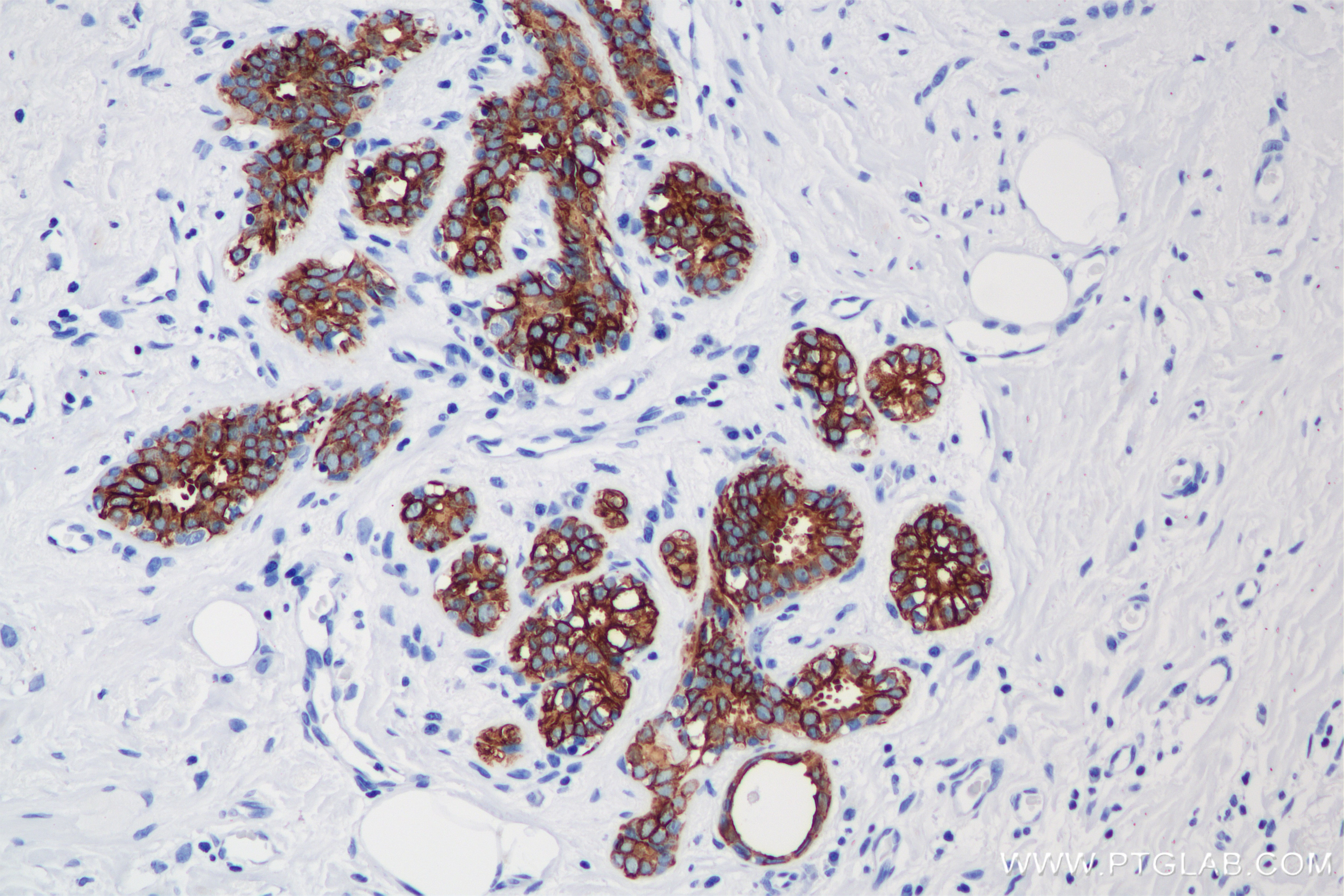 Immunohistochemistry (IHC) staining of human breast cancer tissue using Cytokeratin 7 Recombinant antibody (86153-7-RR)