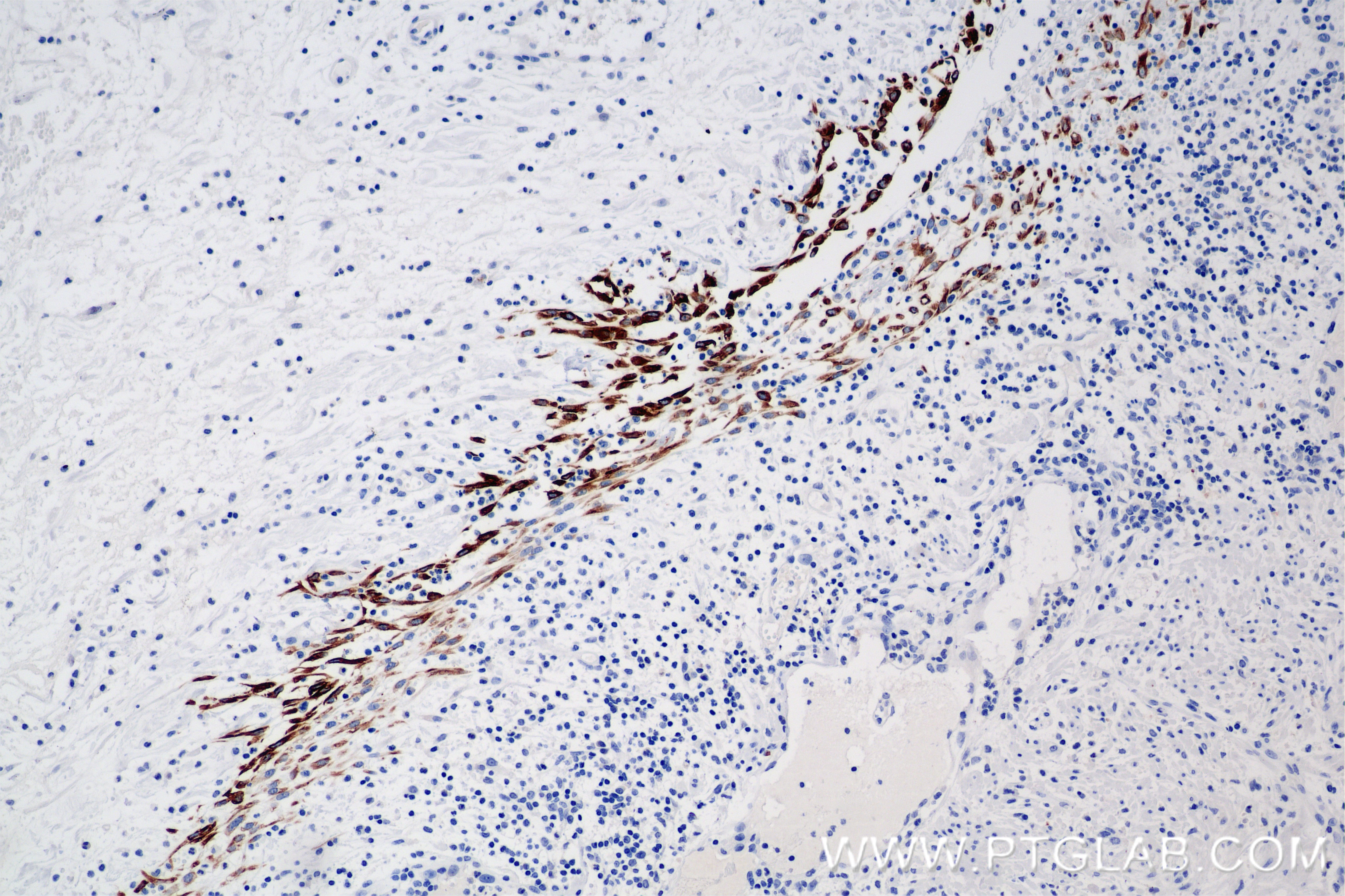 Immunohistochemistry (IHC) staining of human appendicitis tissue using Cytokeratin 7 Recombinant antibody (86153-7-RR)