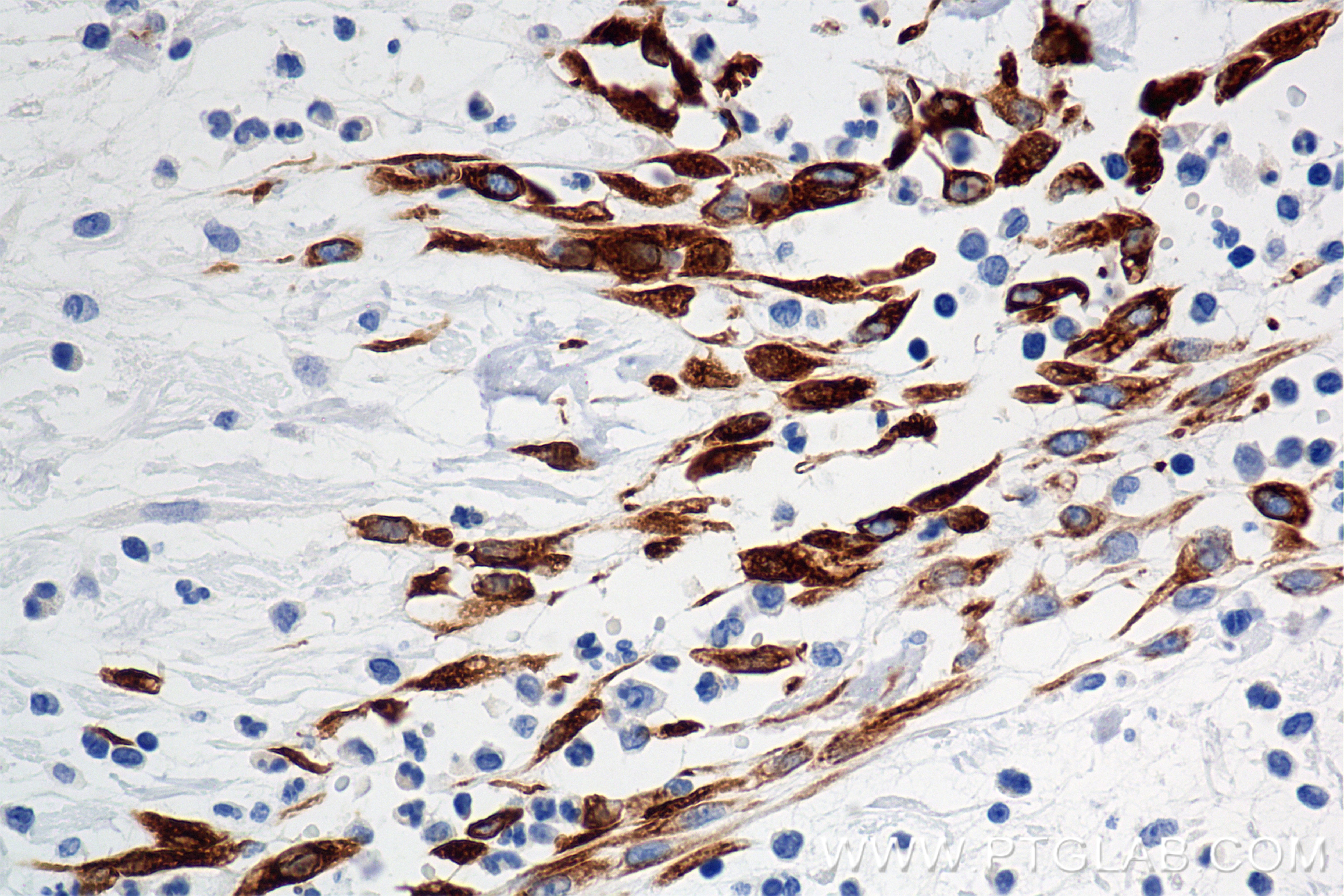 Immunohistochemistry (IHC) staining of human appendicitis tissue using Cytokeratin 7 Recombinant antibody (86153-7-RR)