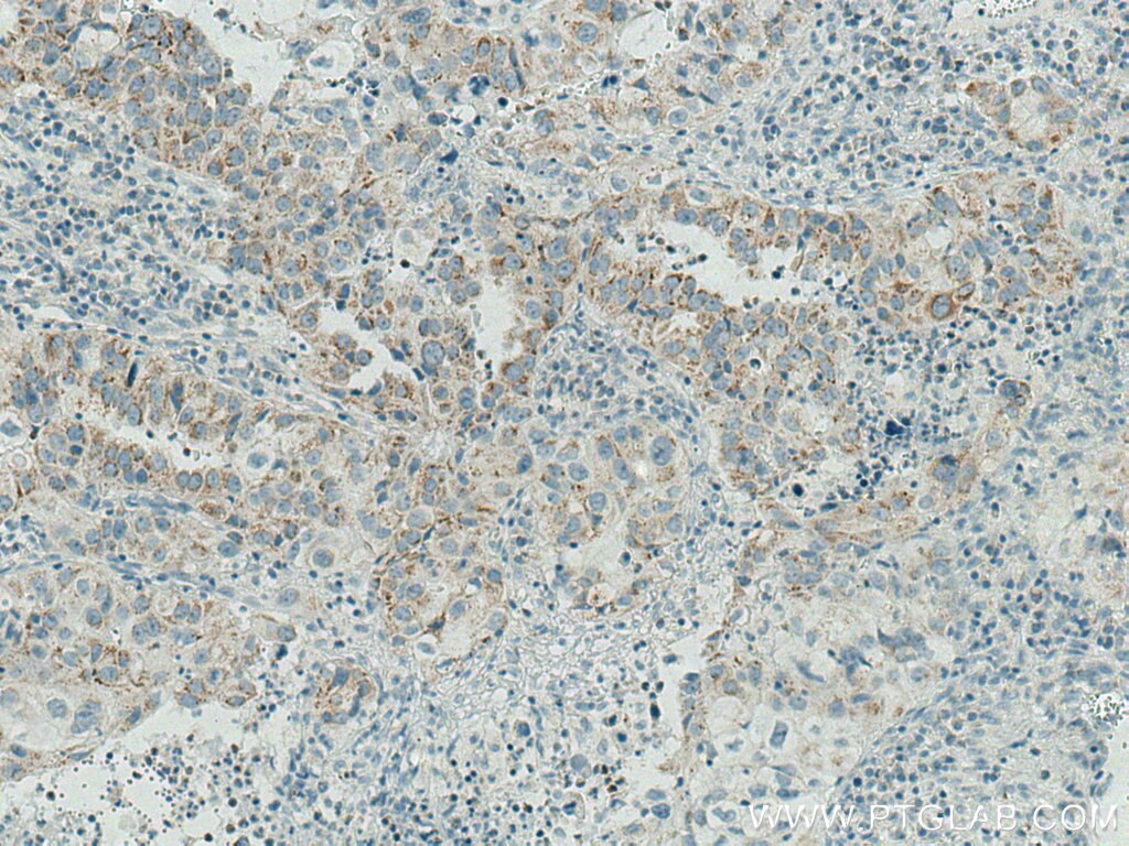 IHC staining of human lung cancer using Biotin-66483