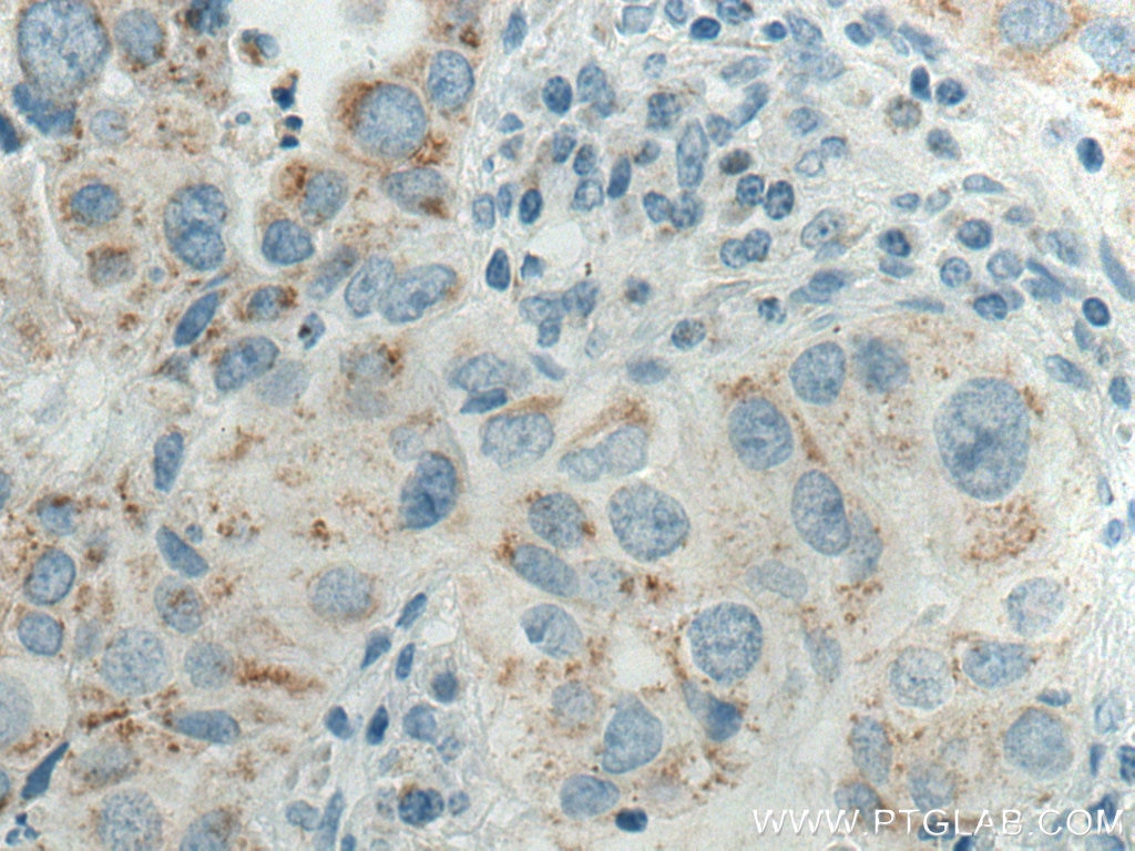 Immunohistochemistry (IHC) staining of human lung cancer tissue using Biotin-conjugated Cytokeratin 7 Monoclonal antibod (Biotin-66483)