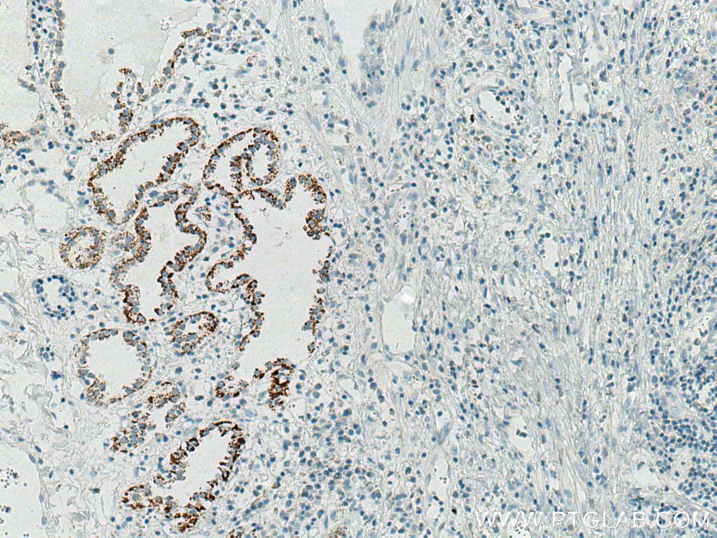 Immunohistochemistry (IHC) staining of human lung cancer tissue using Biotin-conjugated Cytokeratin 7 Monoclonal antibod (Biotin-66483)