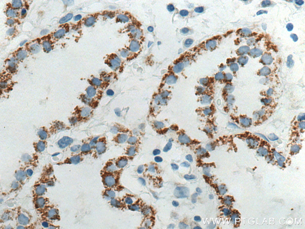 Immunohistochemistry (IHC) staining of human lung cancer tissue using Biotin-conjugated Cytokeratin 7 Monoclonal antibod (Biotin-66483)