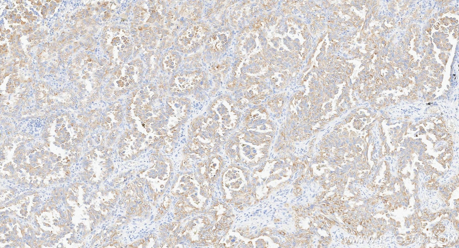 IHC staining of human lung cancer using Biotin-66483 Immunohistochemistry (IHC) staining of human lung cancer tissue using Biotin-conjugated Cytokeratin 7 Monoclonal antibod (Biotin-66483)