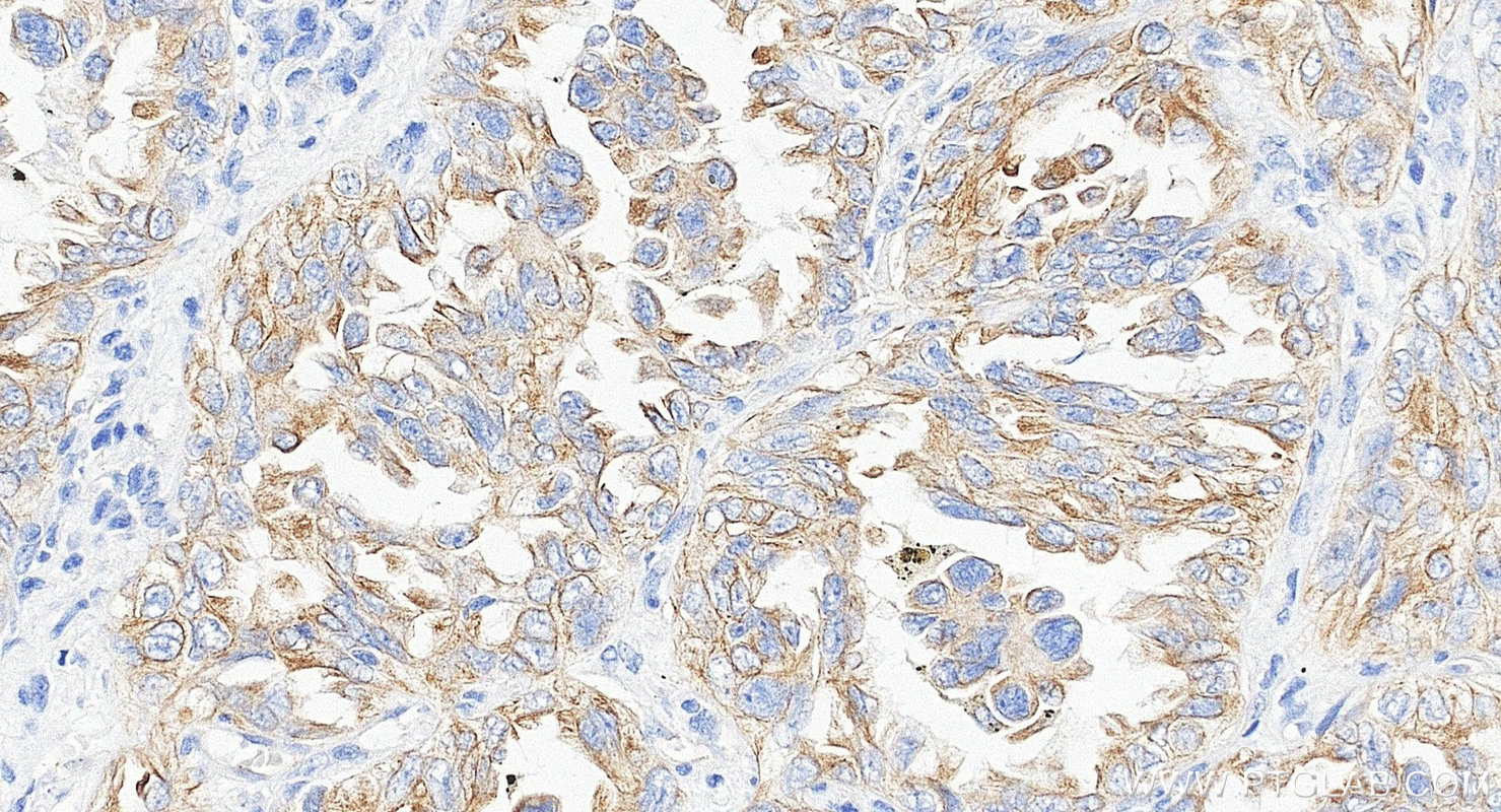 IHC staining of human lung cancer using Biotin-66483 Immunohistochemistry (IHC) staining of human lung cancer tissue using Biotin-conjugated Cytokeratin 7 Monoclonal antibod (Biotin-66483)