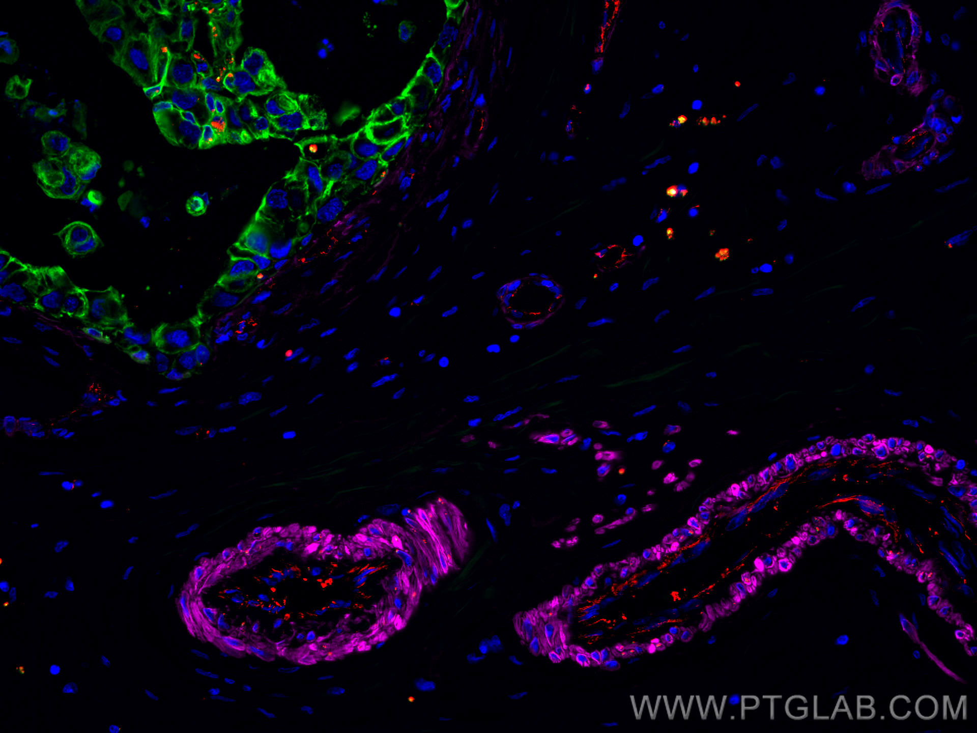 Immunofluorescence (IF) / fluorescent staining of human breast cancer tissue using CoraLite® Plus 488-conjugated Cytokeratin 7 Polycl (CL488-15539)