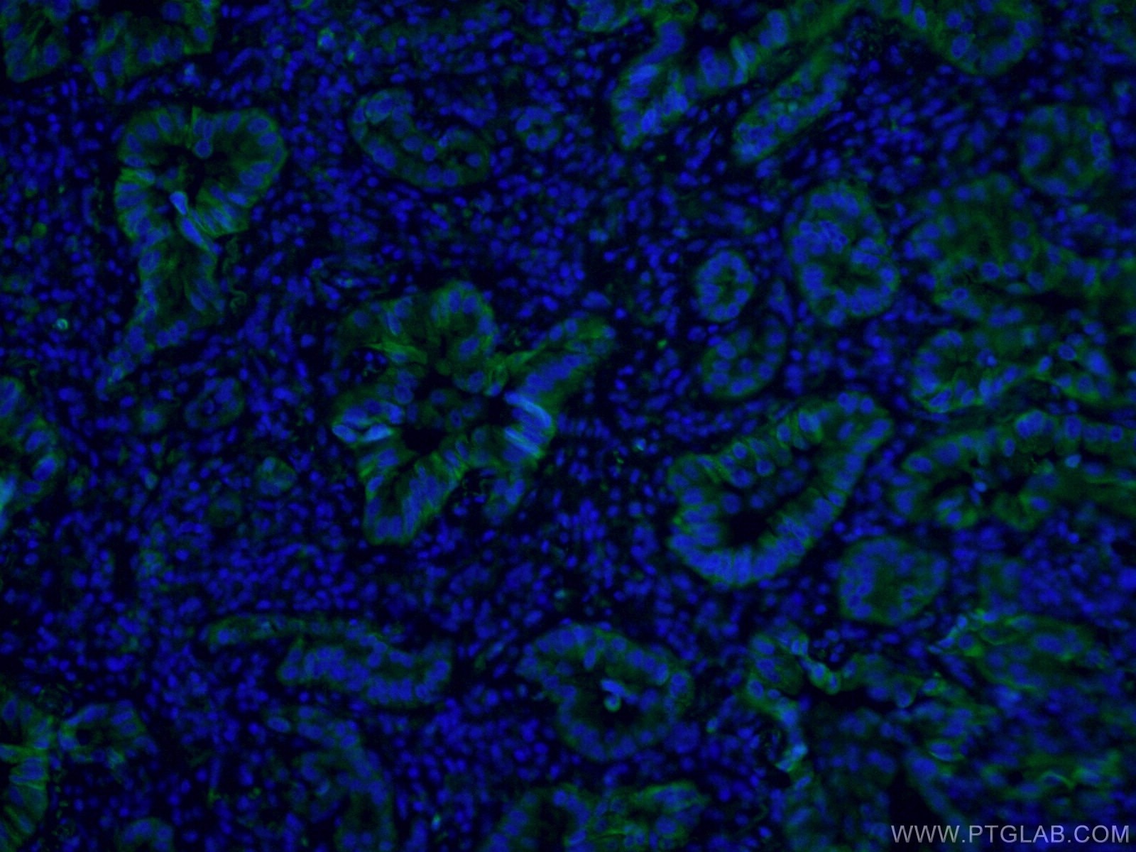 Immunofluorescence (IF) / fluorescent staining of human lung cancer tissue using CoraLite® Plus 488-conjugated Cytokeratin 7 Monocl (CL488-66483)