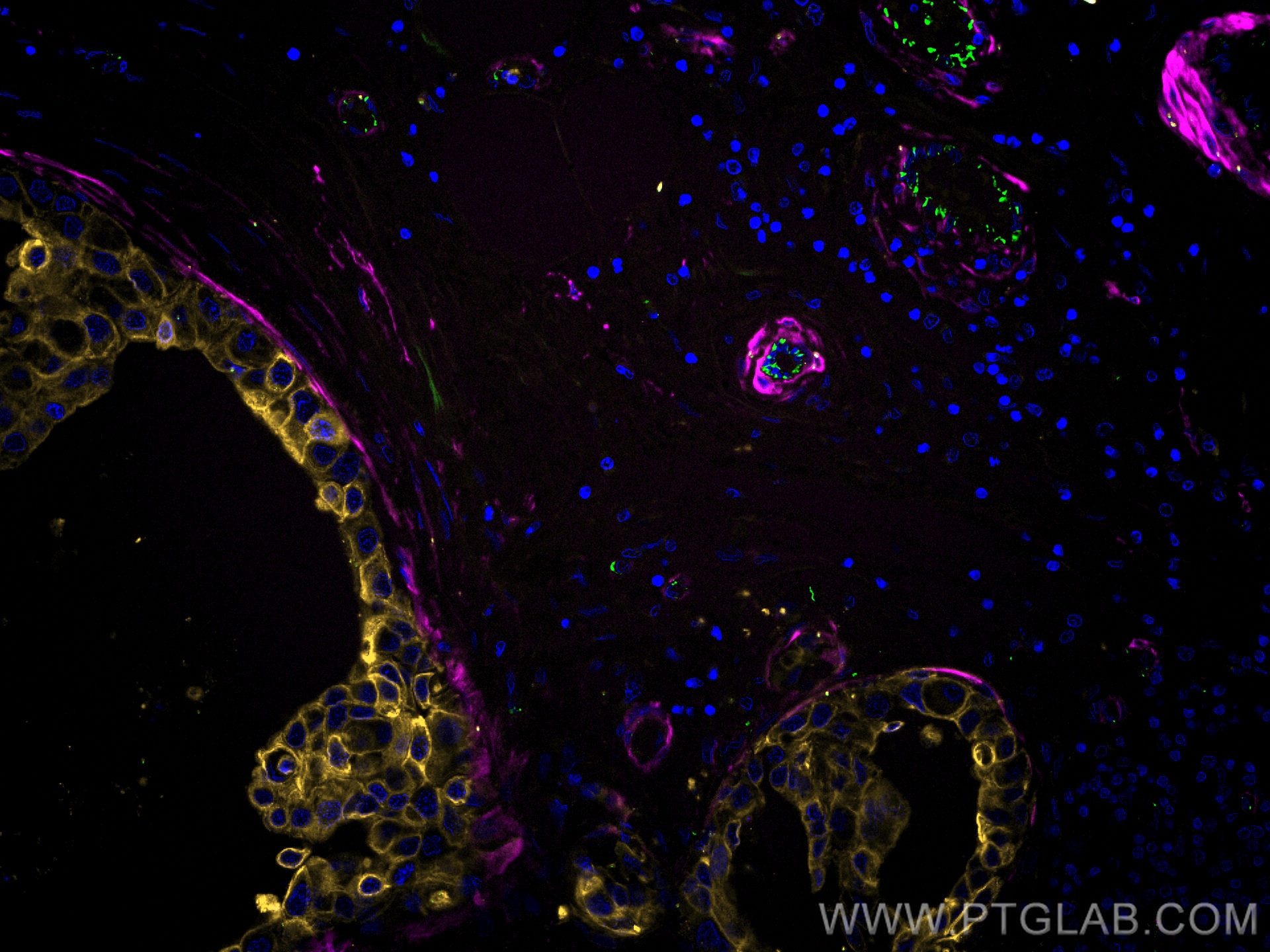 Immunofluorescence (IF) / fluorescent staining of human breast cancer tissue using CoraLite®555-conjugated Cytokeratin 7 Polyclonal a (CL555-15539)