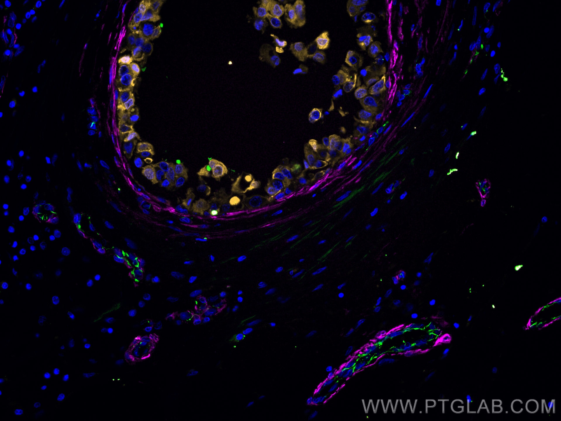 Immunofluorescence (IF) / fluorescent staining of human breast cancer tissue using CoraLite®555-conjugated Cytokeratin 7 Polyclonal a (CL555-15539)