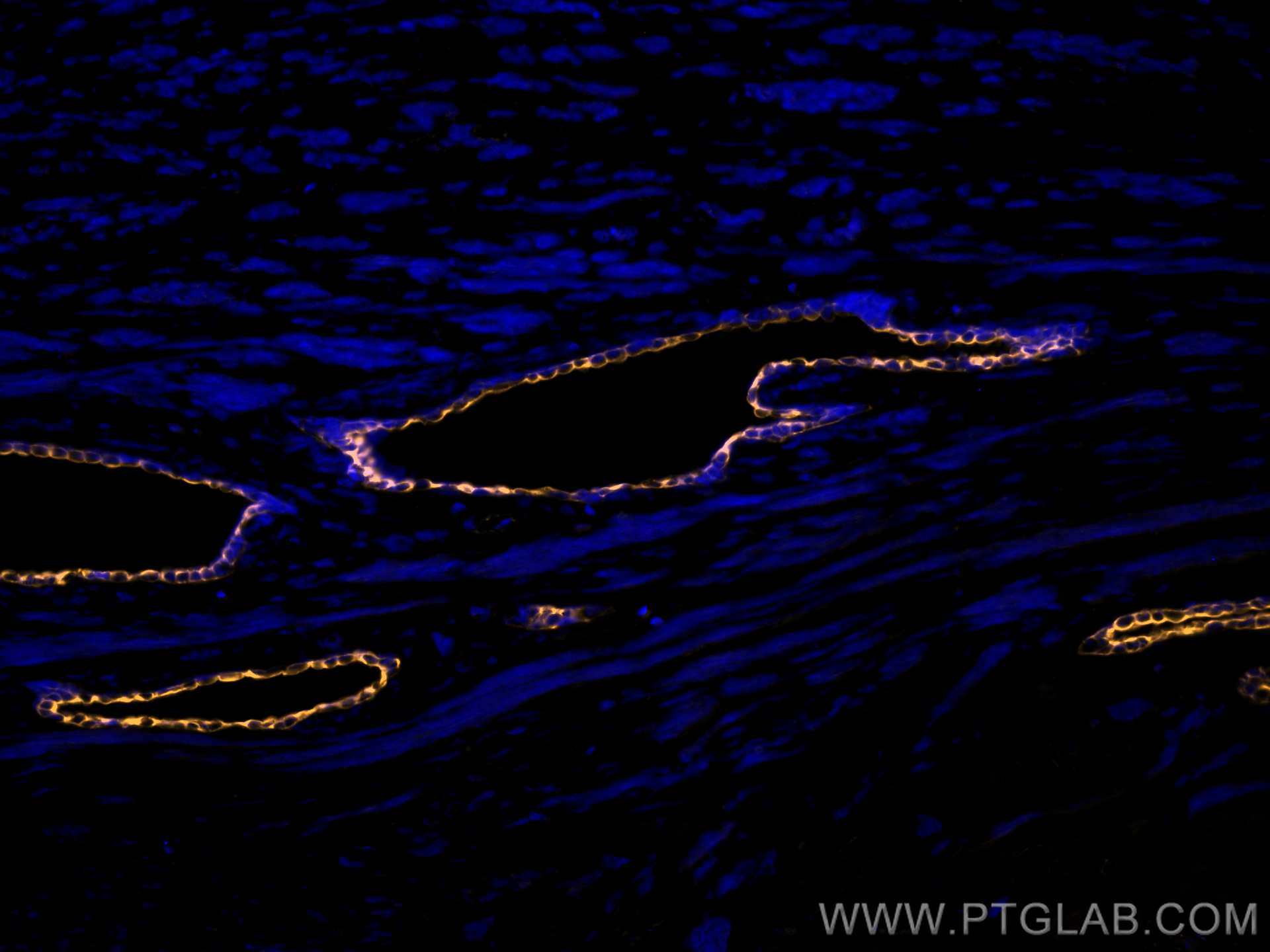 Immunofluorescence (IF) / fluorescent staining of human prostate cancer tissue using CoraLite®555-conjugated Cytokeratin 7 Monoclonal a (CL555-66483)
