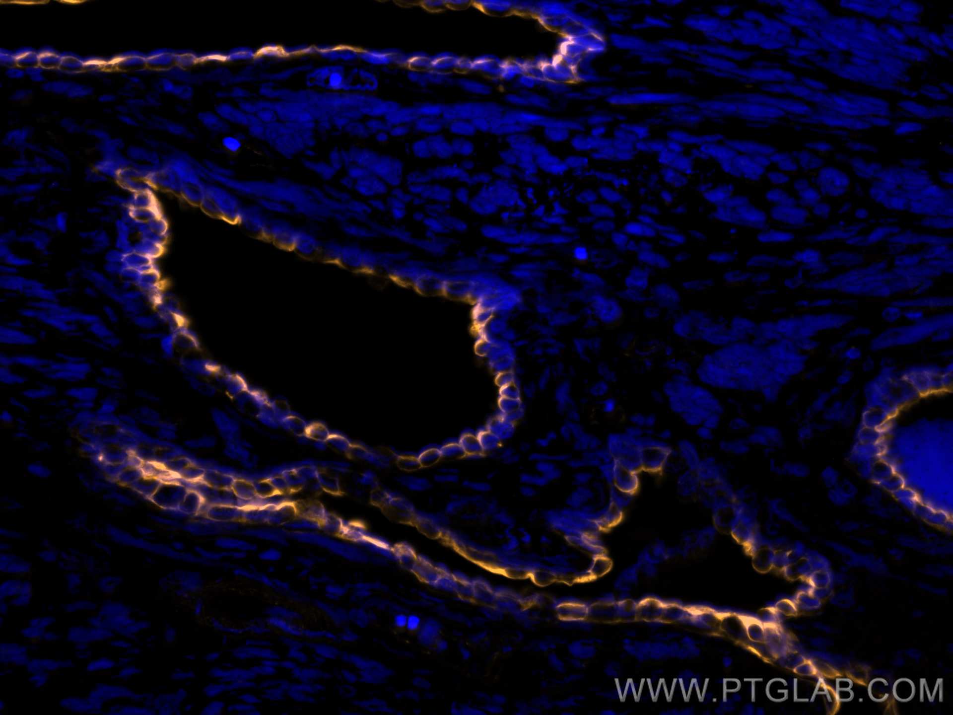 Immunofluorescence (IF) / fluorescent staining of human prostate cancer tissue using CoraLite®555-conjugated Cytokeratin 7 Monoclonal a (CL555-66483)