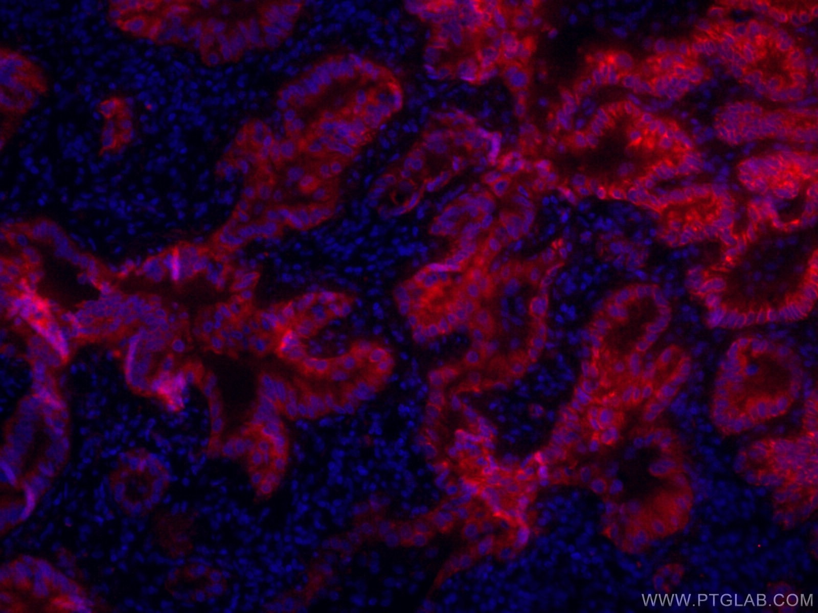 Immunofluorescence (IF) / fluorescent staining of human lung cancer tissue using CoraLite®594-conjugated Cytokeratin 7 Monoclonal a (CL594-66483)