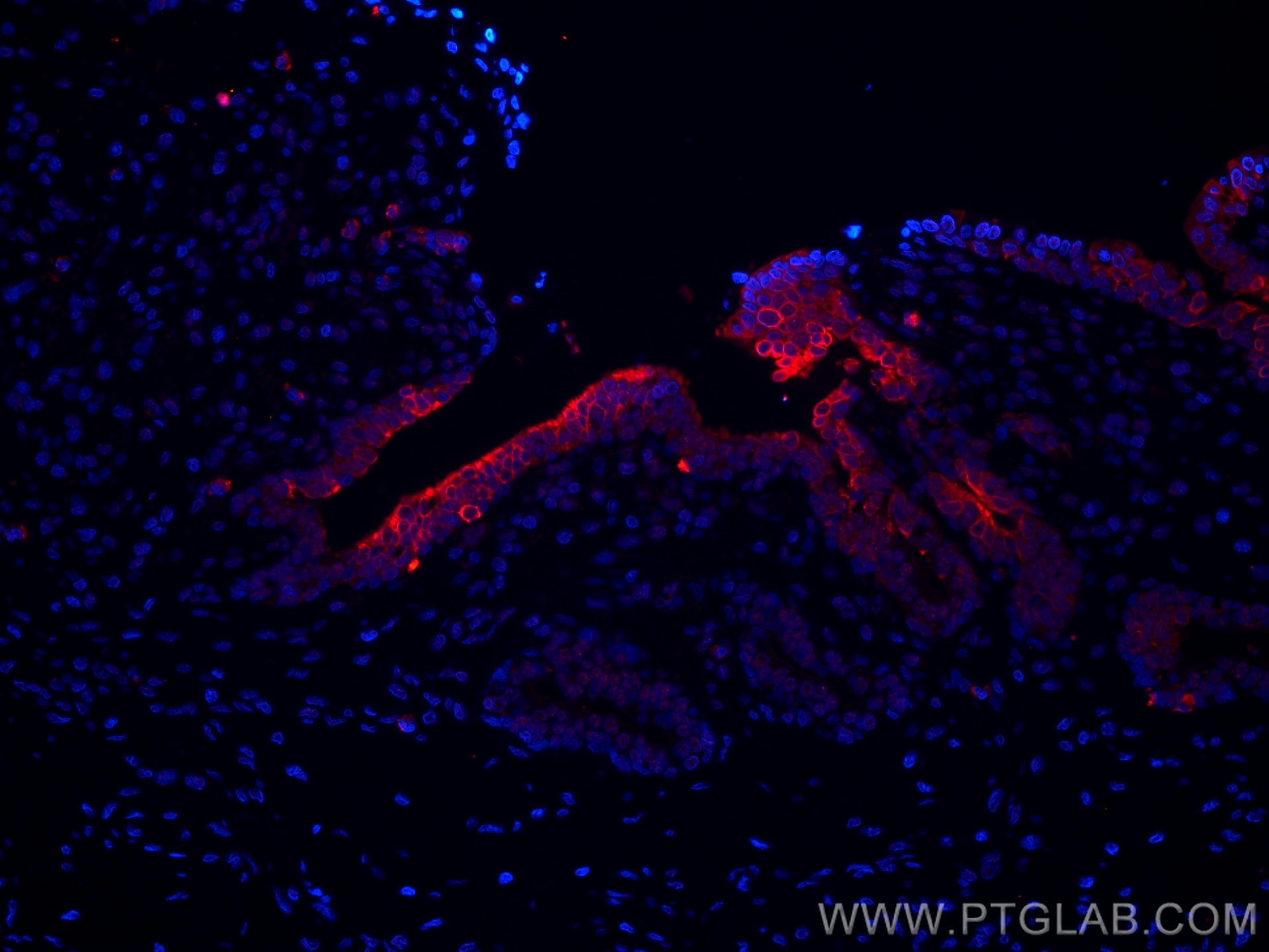 Immunofluorescence (IF) / fluorescent staining of human prostate cancer tissue using CoraLite®594-conjugated Cytokeratin 7 Monoclonal a (CL594-66483)