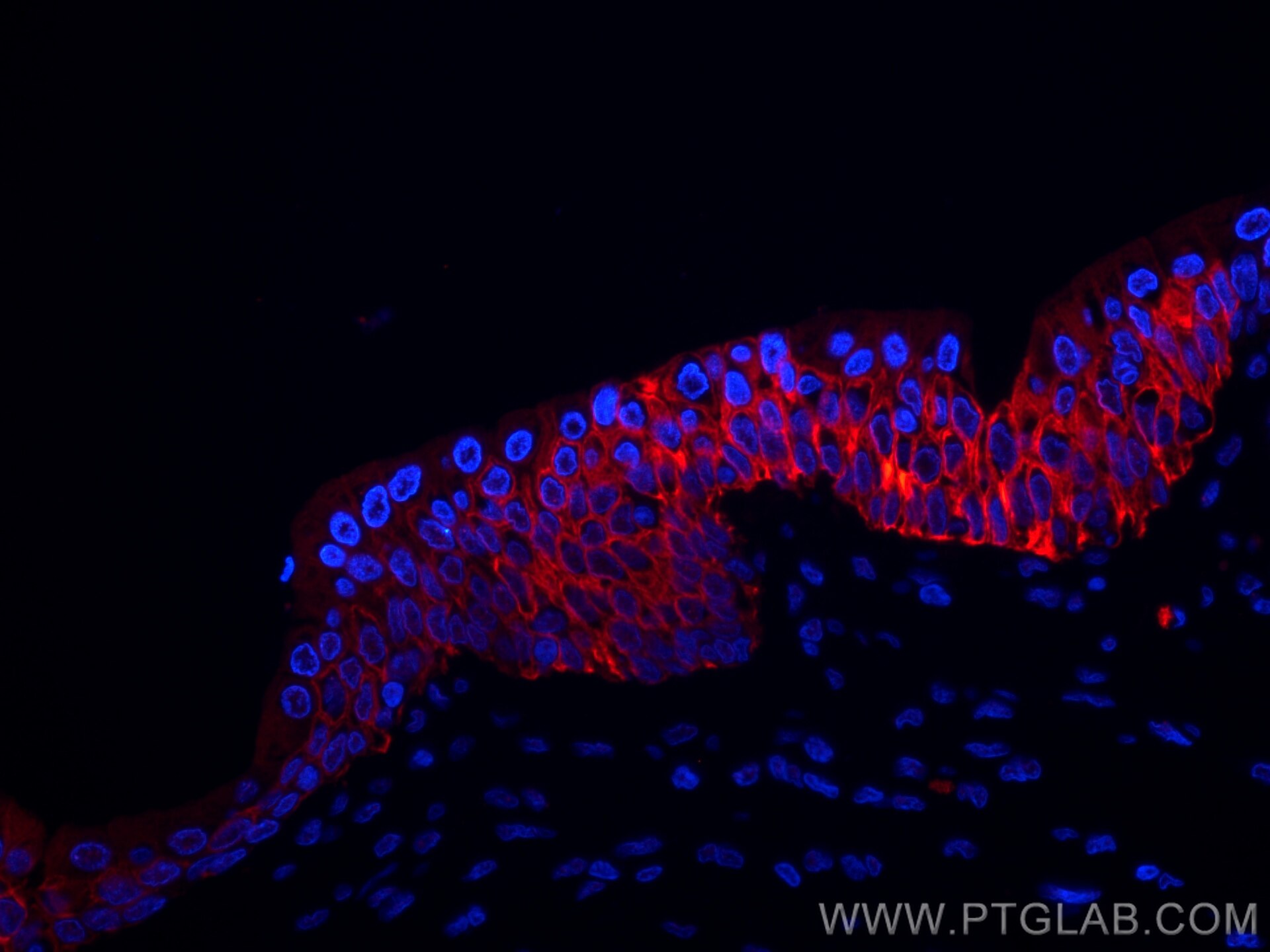 Immunofluorescence (IF) / fluorescent staining of human prostate cancer tissue using CoraLite®594-conjugated Cytokeratin 7 Monoclonal a (CL594-66483)