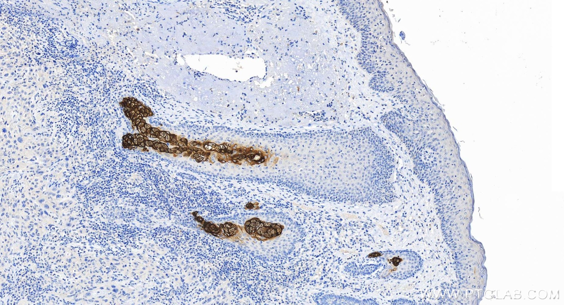 Immunohistochemistry (IHC) staining of human skin cancer tissue using Cytokeratin 79 Recombinant antibody (86310-1-RR)
