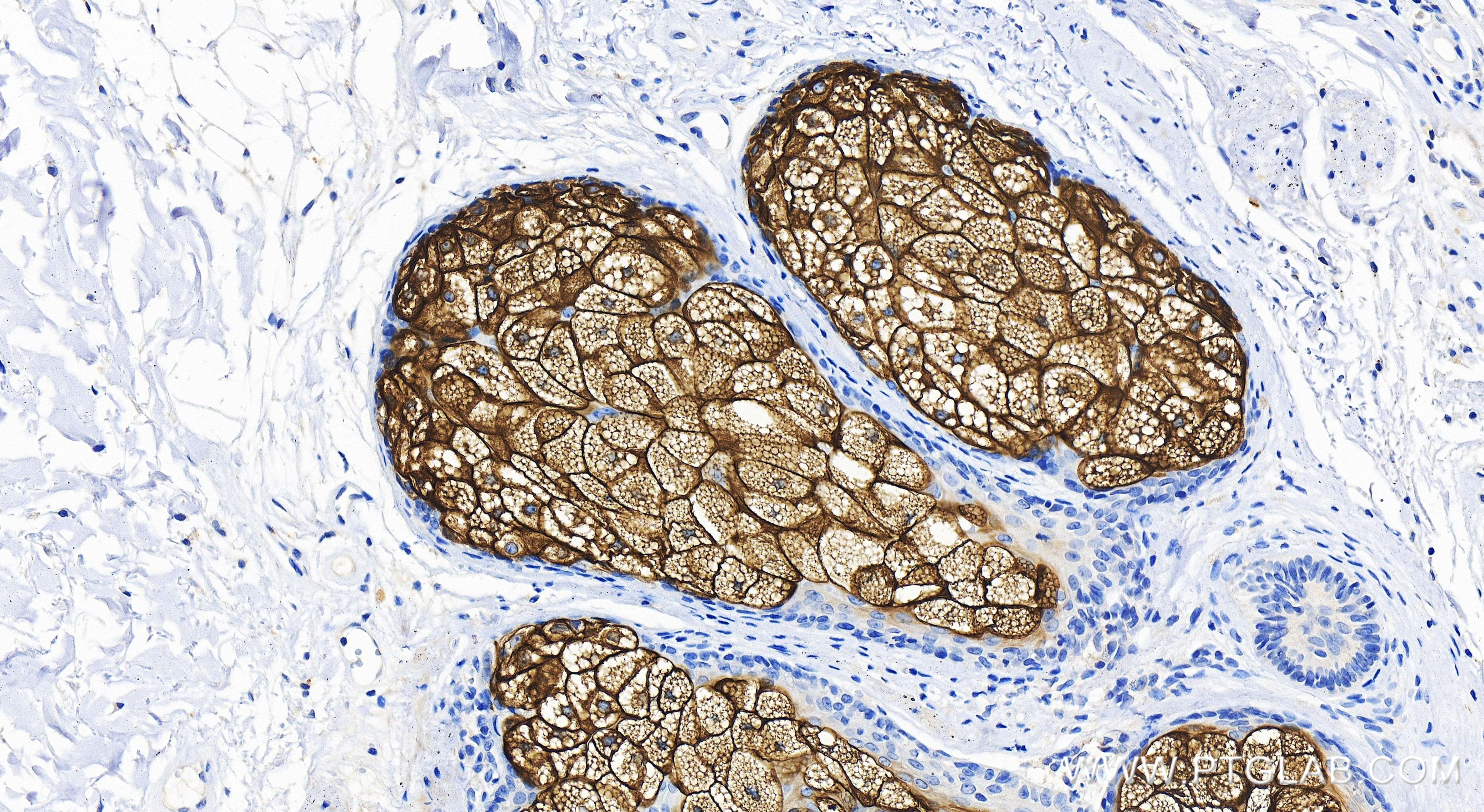 Immunohistochemistry (IHC) staining of human skin cancer tissue using Cytokeratin 79 Recombinant antibody (86310-1-RR)