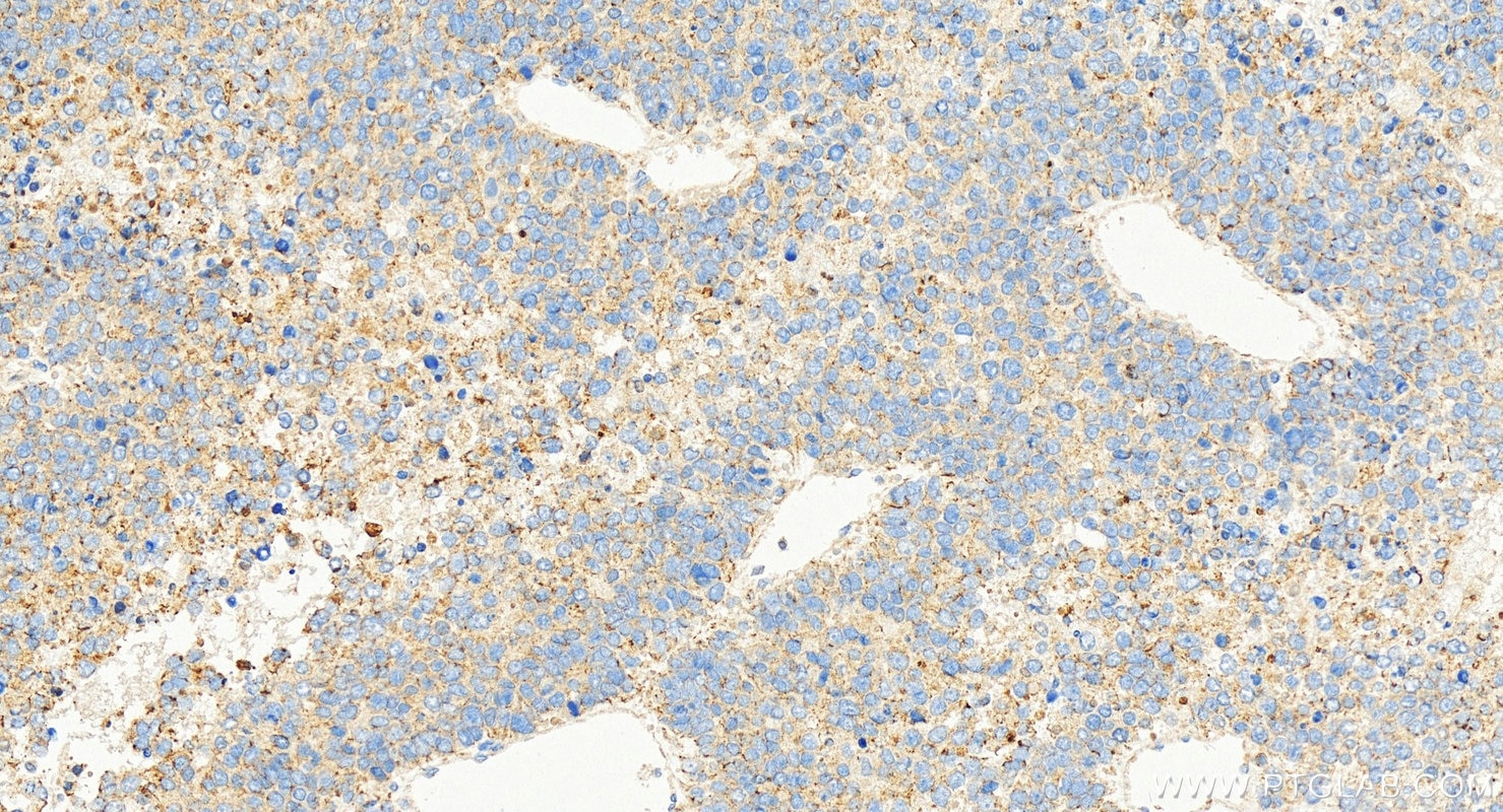 Immunohistochemical analysis of paraffin-embedded human hepatocellular carcinoma slide using 68627-1-Ig (Cytokeratin 8 antibody) at dilution of 1:1000 (under 20x lens). Heat mediated antigen retrieval with Tris-EDTA buffer (pH 9.0). Immunohistochemistry (IHC) staining of human hepatocellular carcinoma using Cytokeratin 8 Monoclonal antibody (68627-1-Ig)