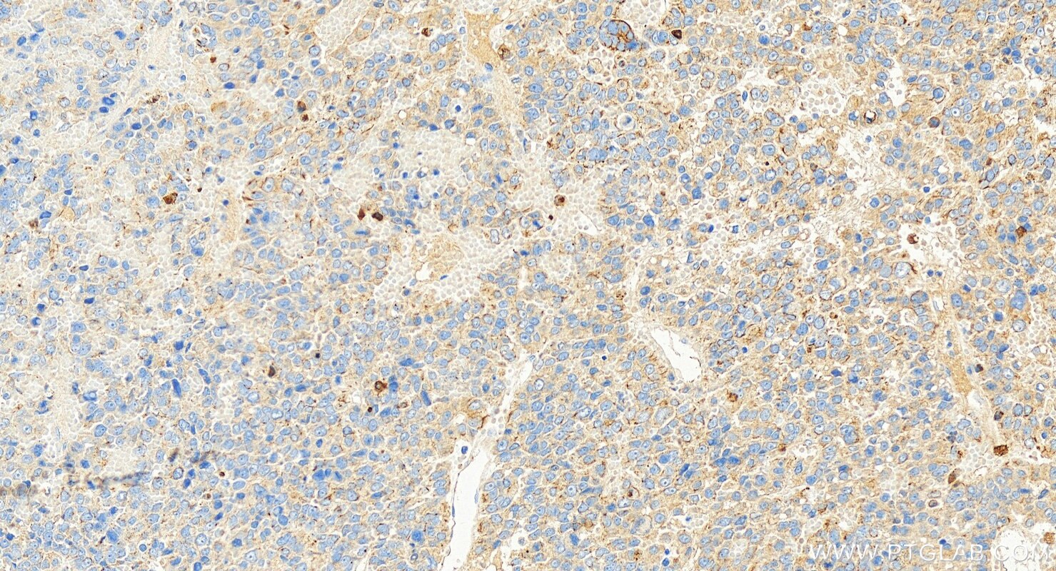 Immunohistochemical analysis of paraffin-embedded human hepatocellular carcinoma slide using 68627-1-Ig (Cytokeratin 8 antibody) at dilution of 1:1000 (under 20x lens). Heat mediated antigen retrieval with Tris-EDTA buffer (pH 9.0). Immunohistochemistry (IHC) staining of human hepatocellular carcinoma using Cytokeratin 8 Monoclonal antibody (68627-1-Ig)