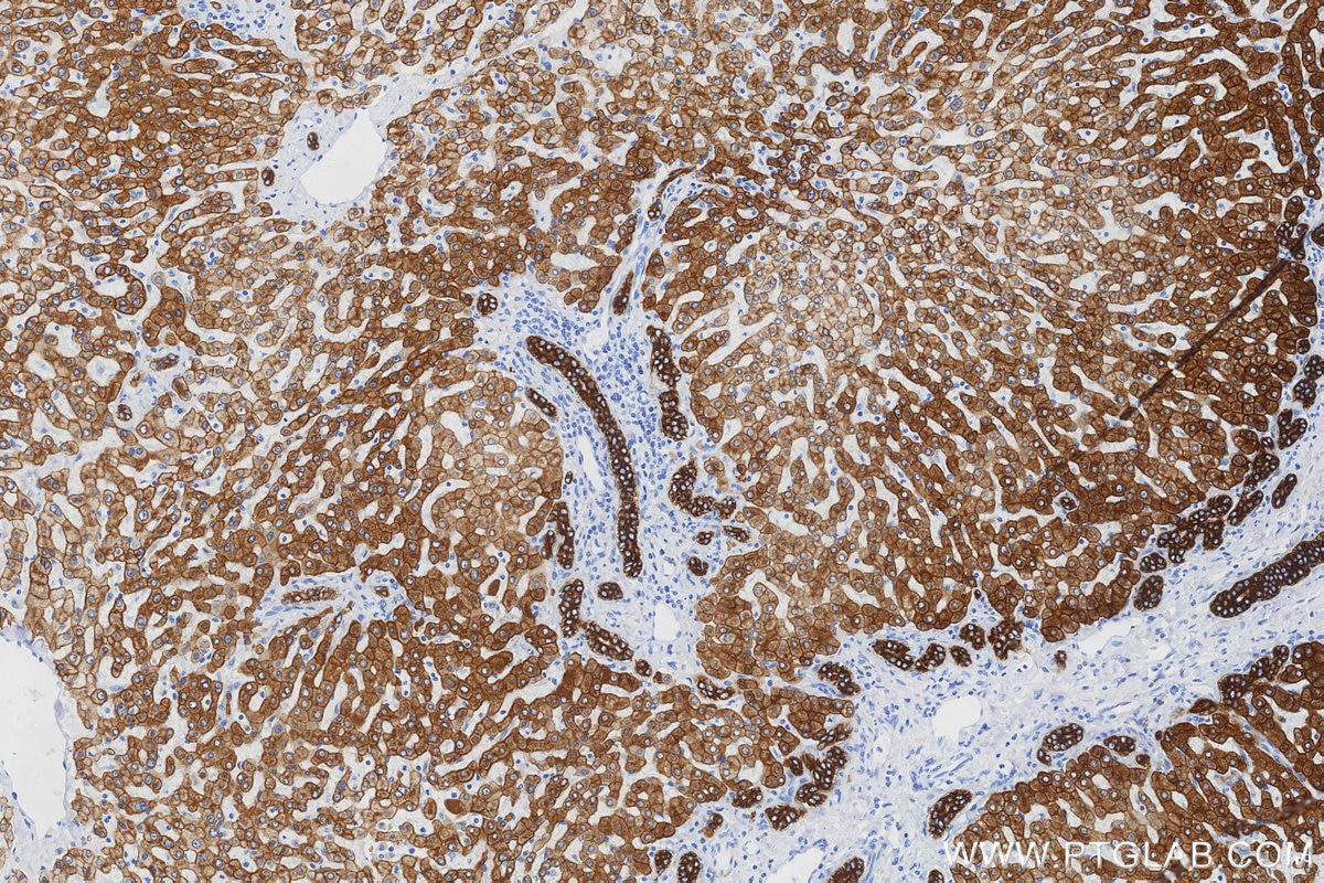 IHC staining of human hepatocirrhosis using 68627-5-Ig Immunohistochemistry (IHC) staining of human hepatocirrhosis tissue using Cytokeratin 8 Monoclonal antibody (68627-5-Ig)
