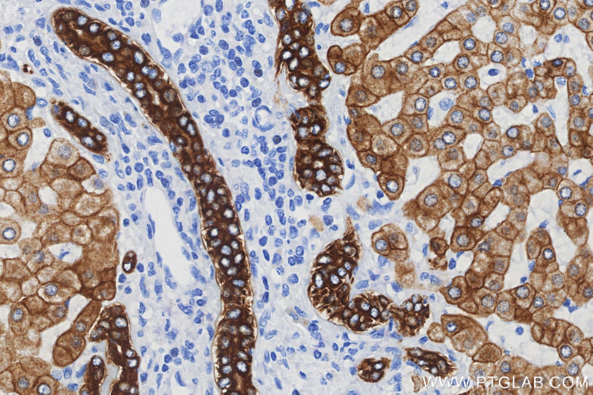 IHC staining of human hepatocirrhosis using 68627-5-Ig Immunohistochemistry (IHC) staining of human hepatocirrhosis tissue using Cytokeratin 8 Monoclonal antibody (68627-5-Ig)