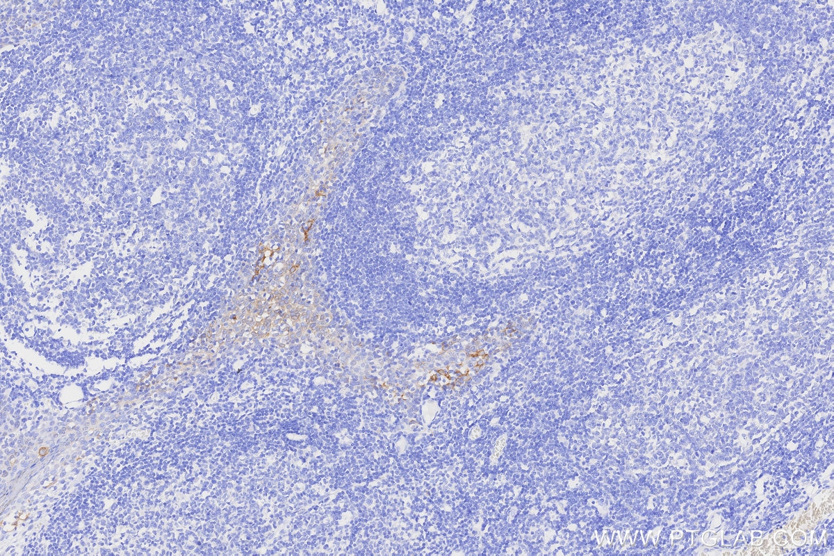 IHC staining of human tonsillitis using 68627-5-Ig Immunohistochemistry (IHC) staining of human tonsillitis tissue using Cytokeratin 8 Monoclonal antibody (68627-5-Ig)