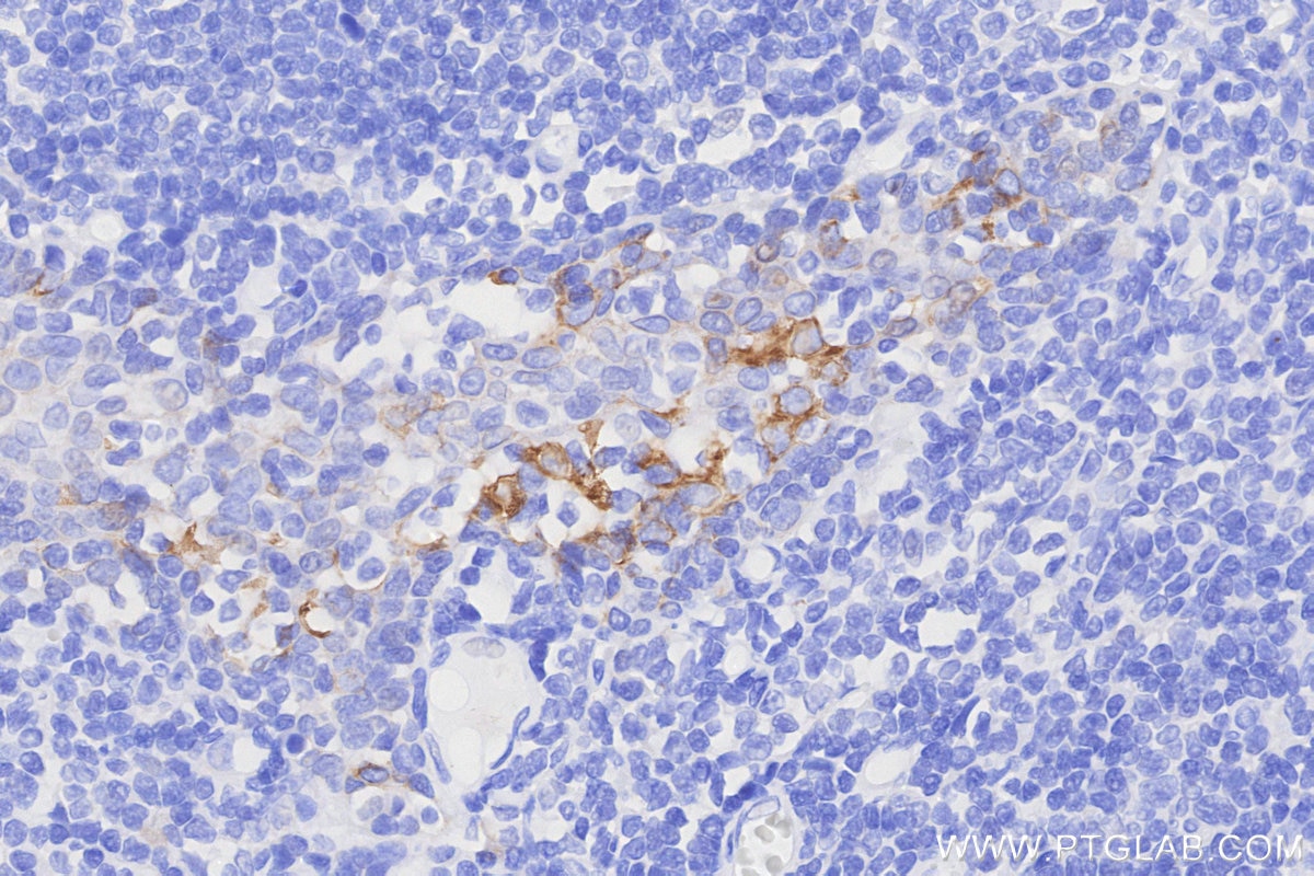 IHC staining of human tonsillitis using 68627-5-Ig Immunohistochemistry (IHC) staining of human tonsillitis tissue using Cytokeratin 8 Monoclonal antibody (68627-5-Ig)