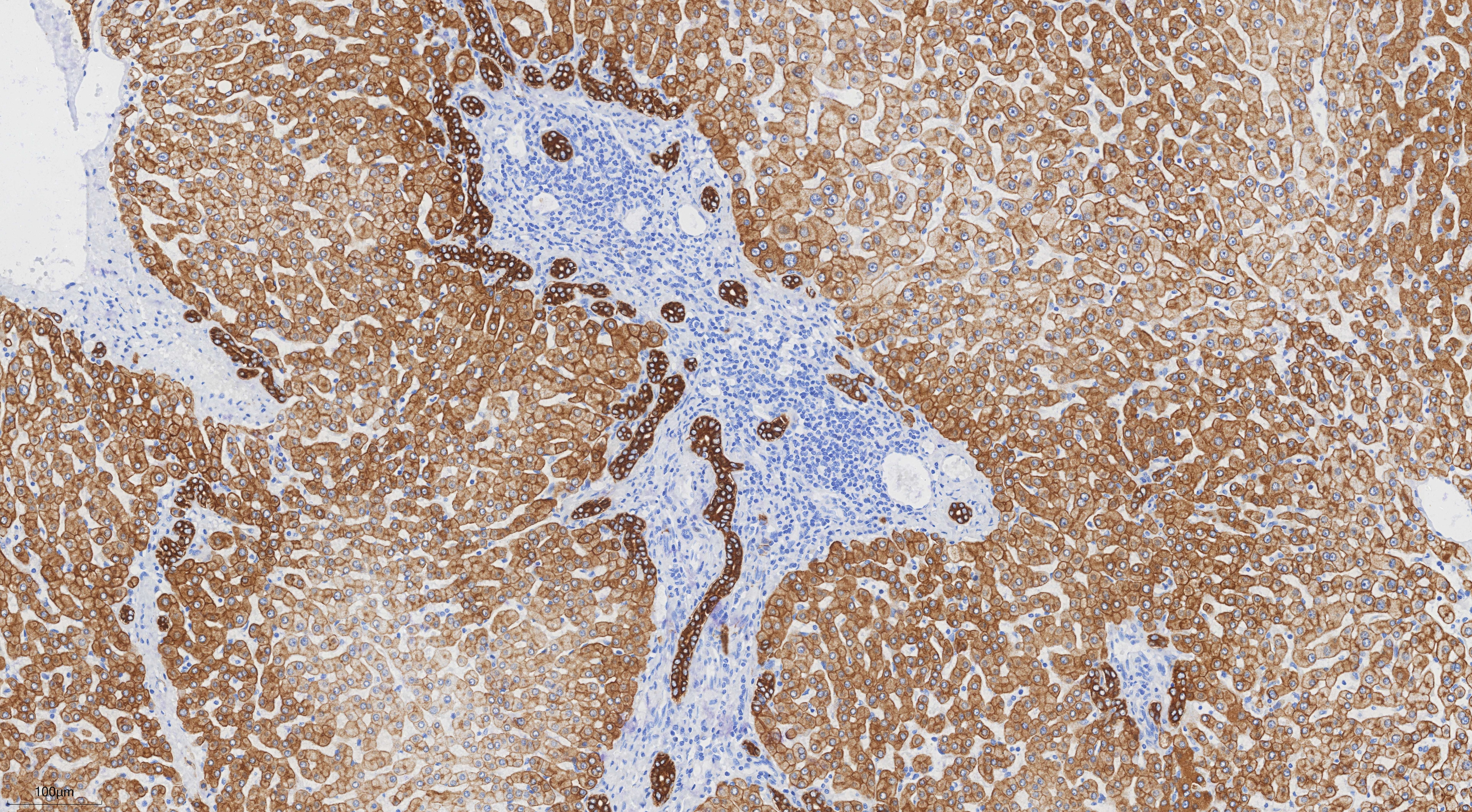 IHC staining of human hepatocirrhosis using 68627-5-Ig Immunohistochemistry (IHC) staining of human hepatocirrhosis tissue using Cytokeratin 8 Monoclonal antibody (68627-5-Ig)