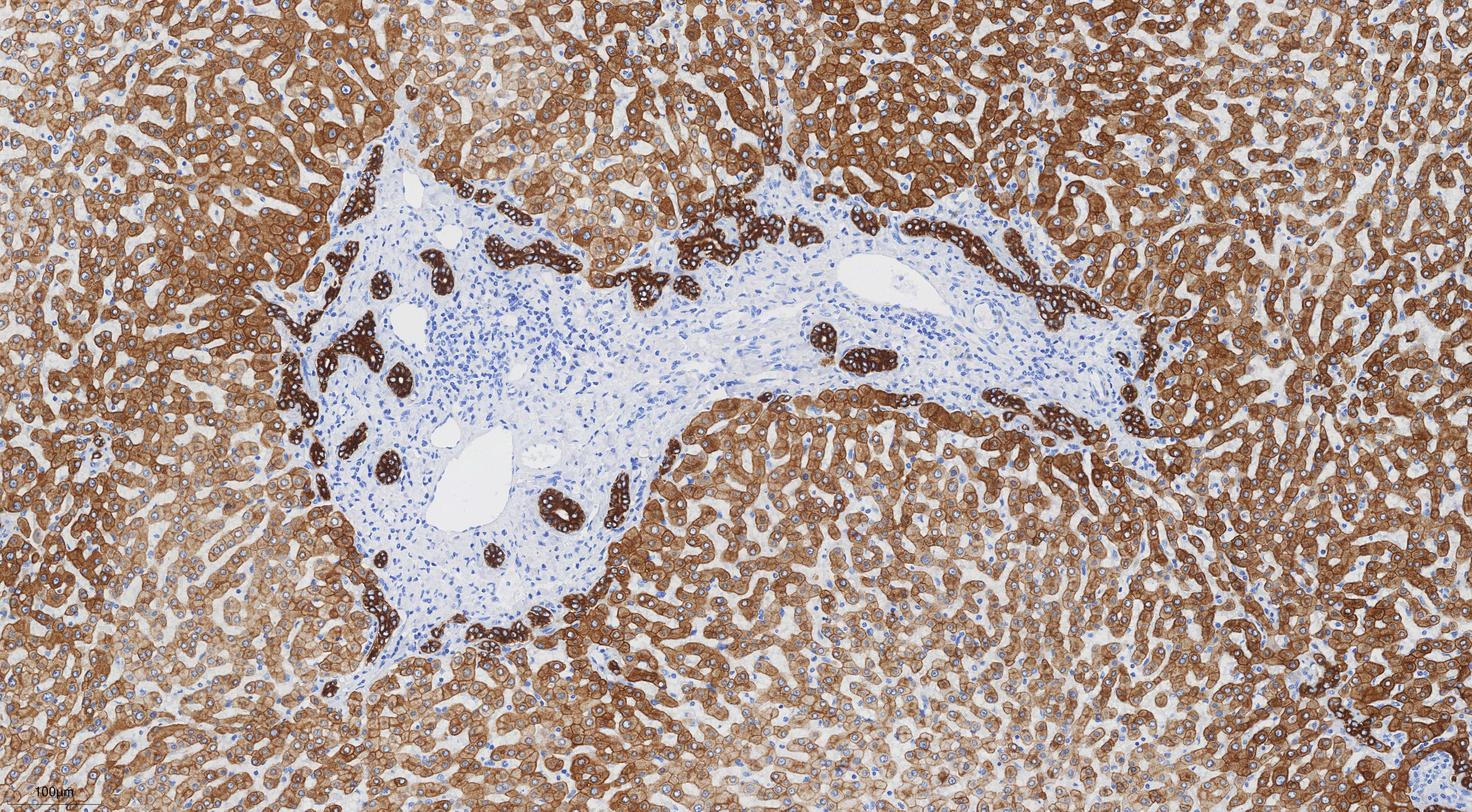 IHC staining of human hepatocirrhosis using 68627-5-Ig Immunohistochemistry (IHC) staining of human hepatocirrhosis tissue using Cytokeratin 8 Monoclonal antibody (68627-5-Ig)