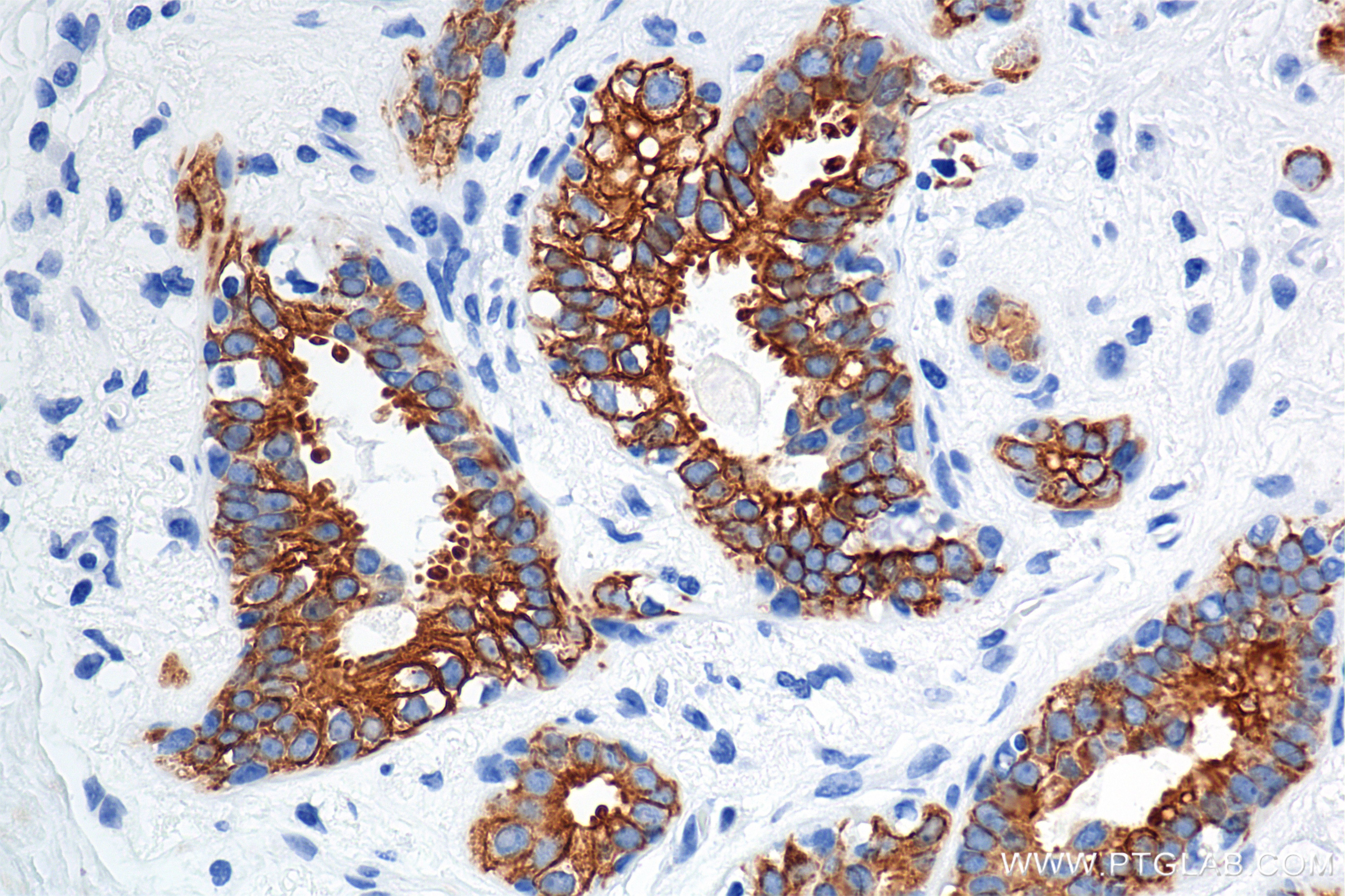 Immunohistochemical analysis of paraffin-embedded human breast cancer tissue slide using 86457-4-RR (Cytokeratin 8 antibody) at dilution of 1:2000 (under 40x lens). Heat mediated antigen retrieval with Tris-EDTA buffer (pH 9.0). This data was developed using the same antibody clone with 86457-4-PBS in a different storage buffer formulation. Immunohistochemistry (IHC) staining of human breast cancer tissue using Cytokeratin 8 Recombinant monoclonal antibody (86457-4-RR)