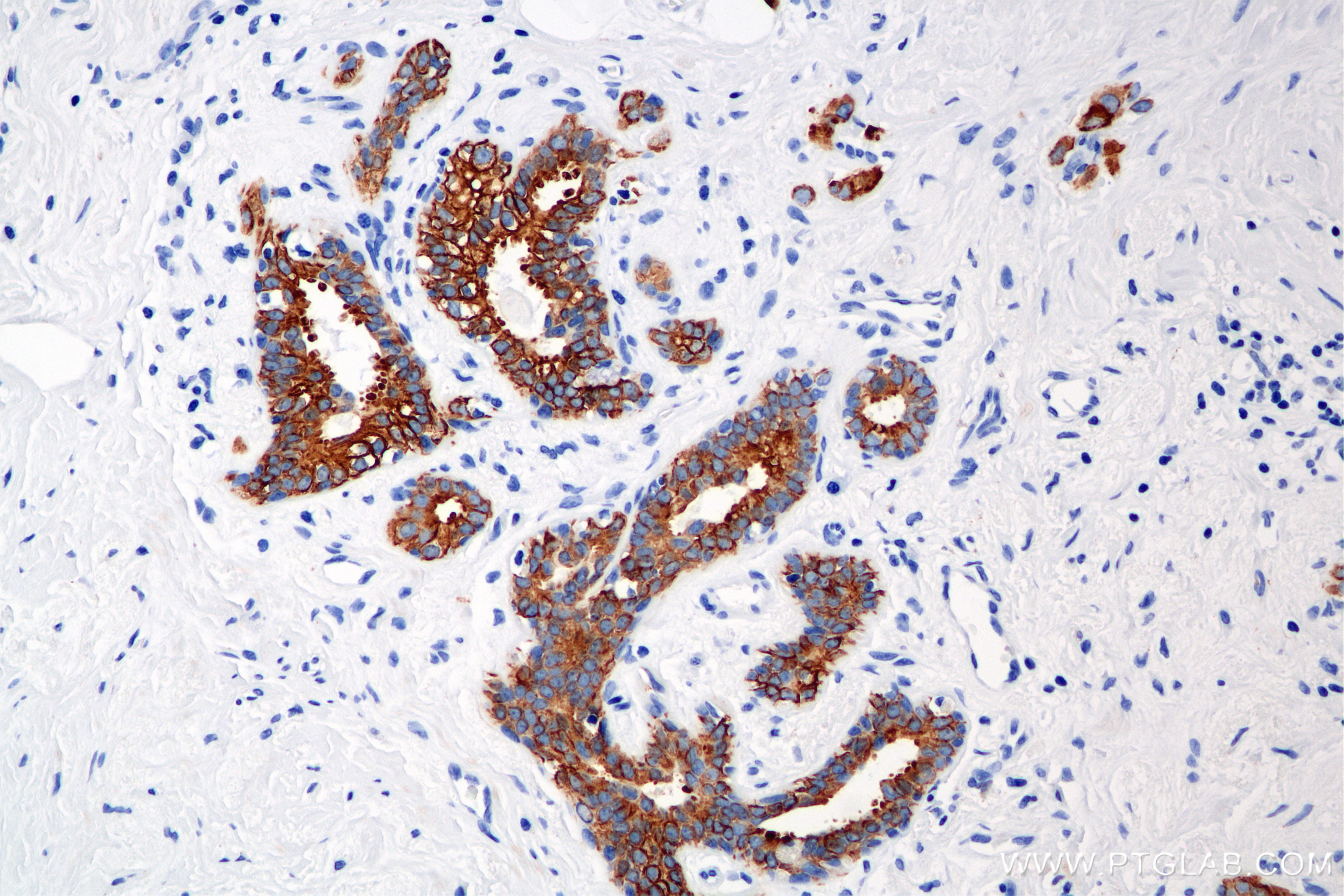 Immunohistochemical analysis of paraffin-embedded human breast cancer tissue slide using 86457-4-RR (Cytokeratin 8 antibody) at dilution of 1:2000 (under 20x lens). Heat mediated antigen retrieval with Tris-EDTA buffer (pH 9.0). This data was developed using the same antibody clone with 86457-4-PBS in a different storage buffer formulation. Immunohistochemistry (IHC) staining of human breast cancer tissue using Cytokeratin 8 Recombinant monoclonal antibody (86457-4-RR)