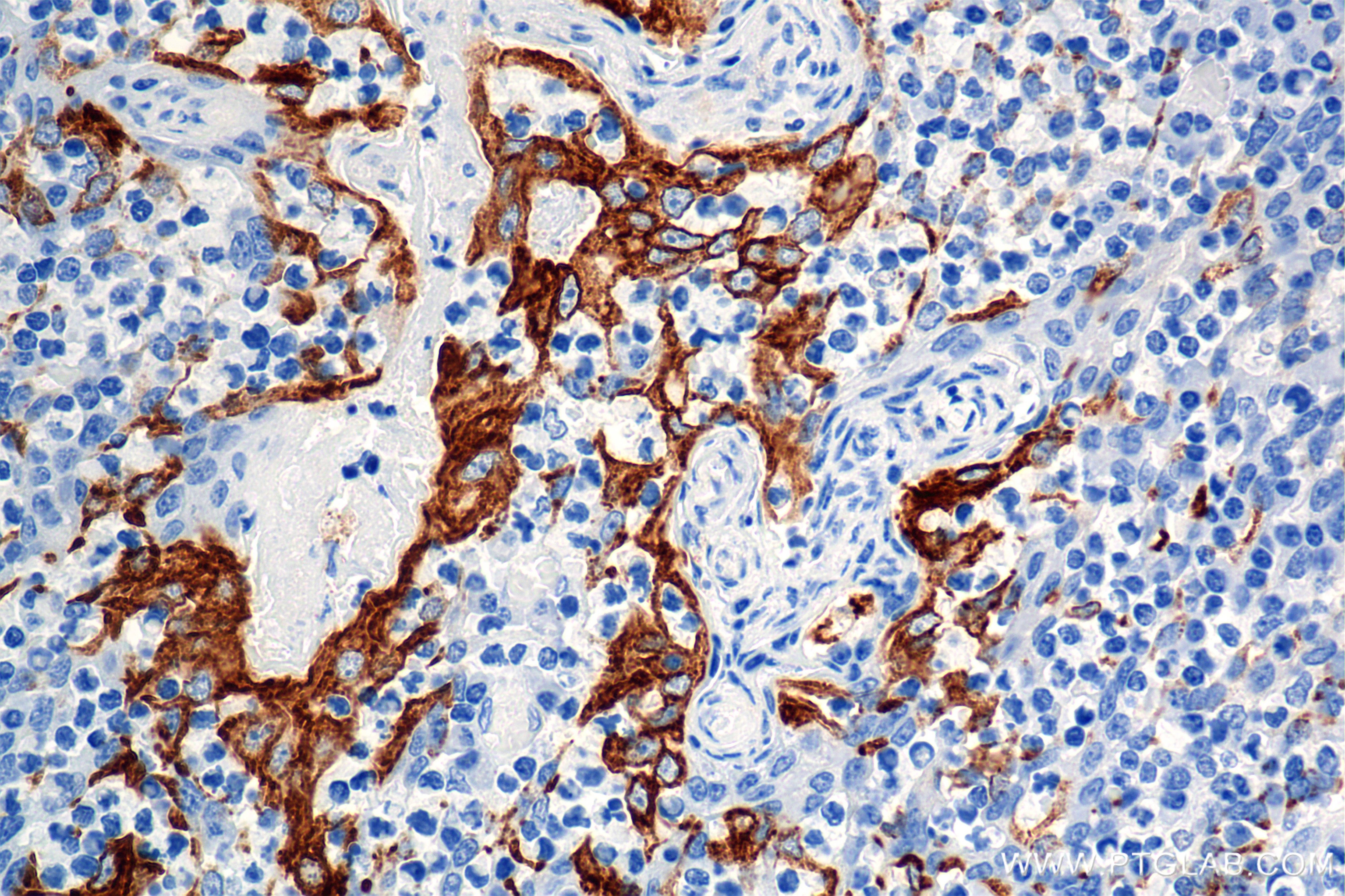 Immunohistochemical analysis of paraffin-embedded human tonsil tissue slide using 86457-4-RR (Cytokeratin 8 antibody) at dilution of 1:2000 (under 40x lens). Heat mediated antigen retrieval with Tris-EDTA buffer (pH 9.0). This data was developed using the same antibody clone with 86457-4-PBS in a different storage buffer formulation. Immunohistochemistry (IHC) staining of human tonsil tissue using Cytokeratin 8 Recombinant monoclonal antibody (86457-4-RR)