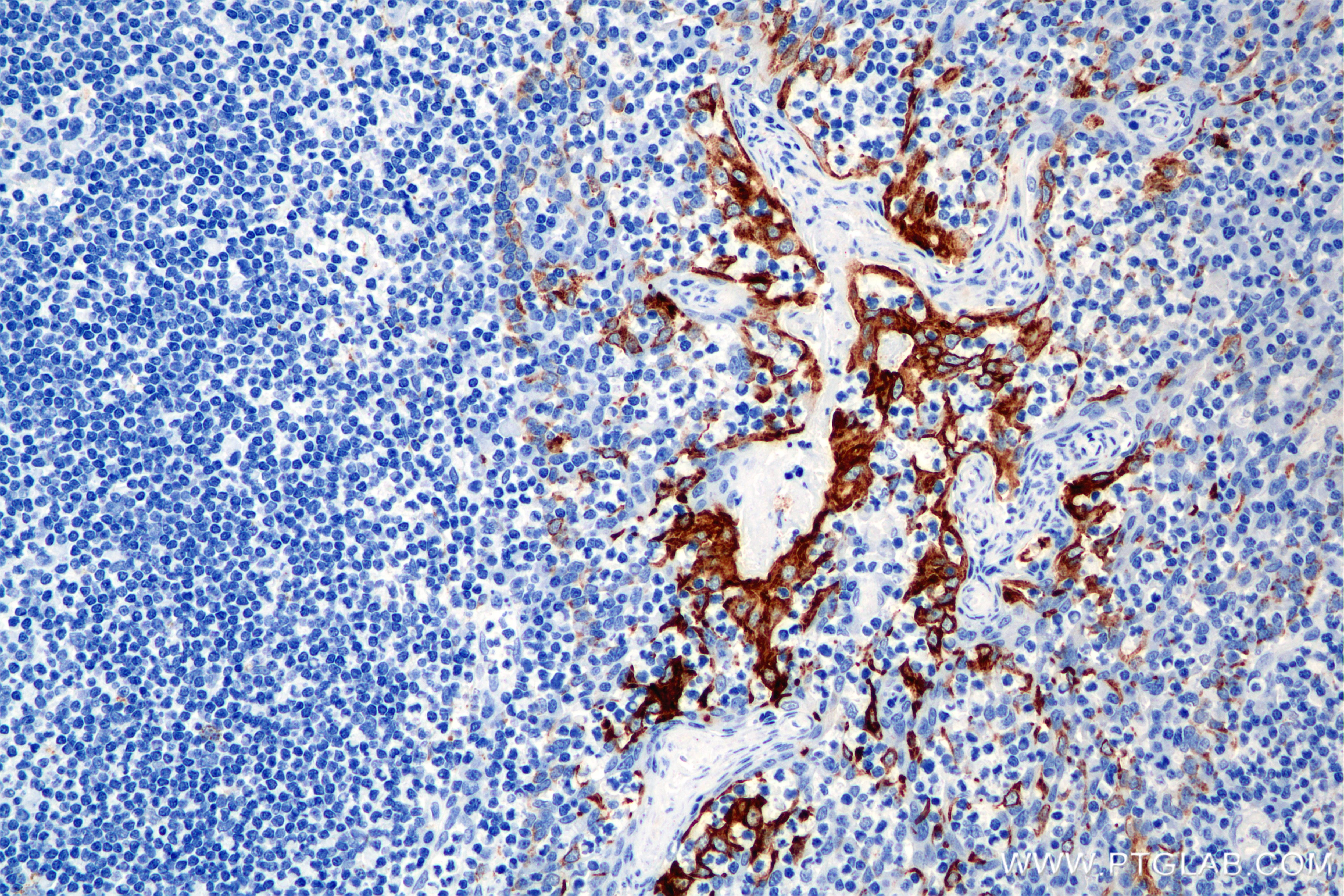 Immunohistochemical analysis of paraffin-embedded human tonsil tissue slide using 86457-4-RR (Cytokeratin 8 antibody) at dilution of 1:2000 (under 20x lens). Heat mediated antigen retrieval with Tris-EDTA buffer (pH 9.0). This data was developed using the same antibody clone with 86457-4-PBS in a different storage buffer formulation. Immunohistochemistry (IHC) staining of human tonsil tissue using Cytokeratin 8 Recombinant monoclonal antibody (86457-4-RR)