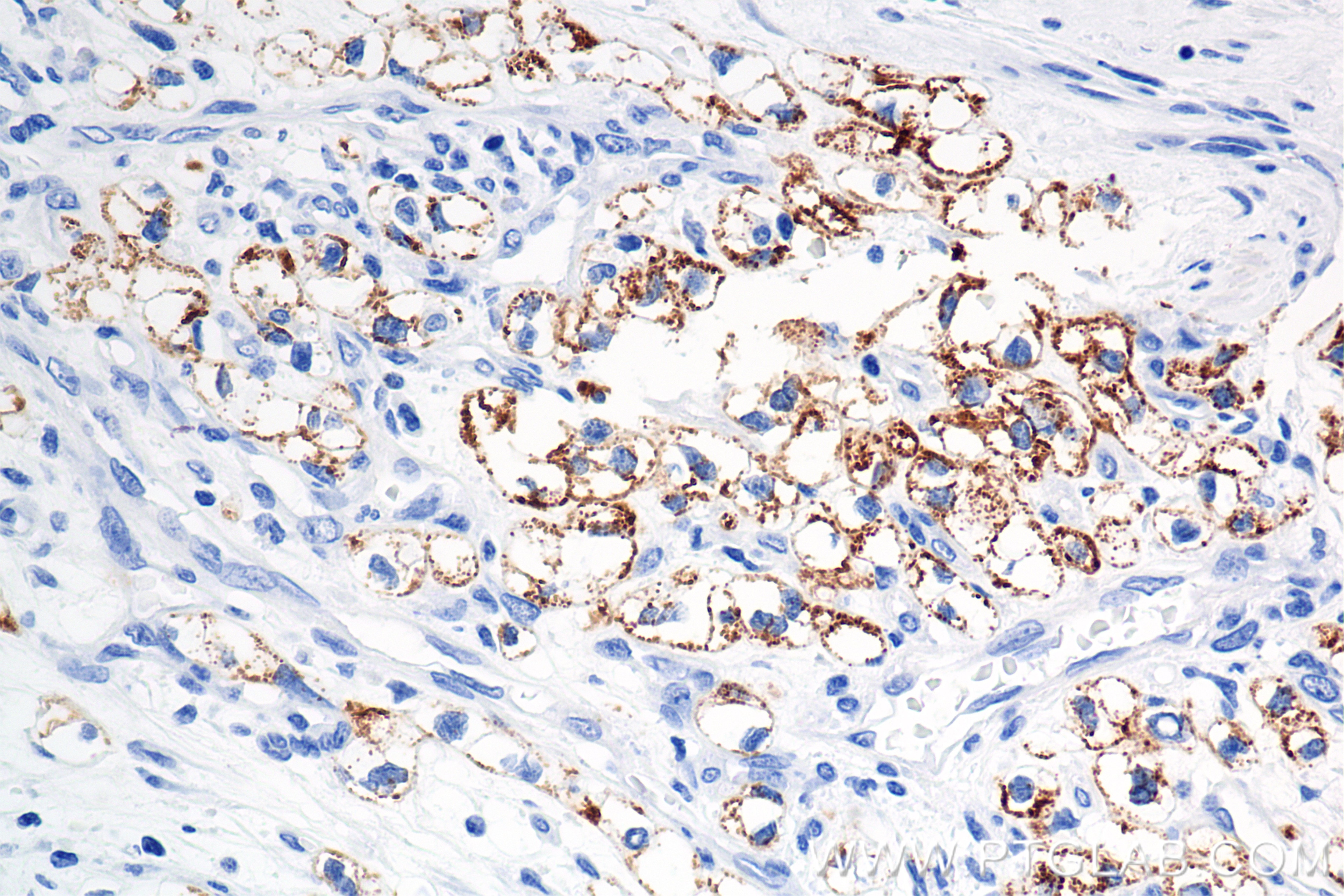 Immunohistochemical analysis of paraffin-embedded Human Kidney(renal cell) Cancer slide using 86457-4-RR (Cytokeratin 8 antibody) at dilution of 1:2000 (under 40x lens). Heat mediated antigen retrieval with Tris-EDTA buffer (pH 9.0). This data was developed using the same antibody clone with 86457-4-PBS in a different storage buffer formulation. Immunohistochemistry (IHC) staining of Human Kidney(renal cell) Cancer using Cytokeratin 8 Recombinant monoclonal antibody (86457-4-RR)