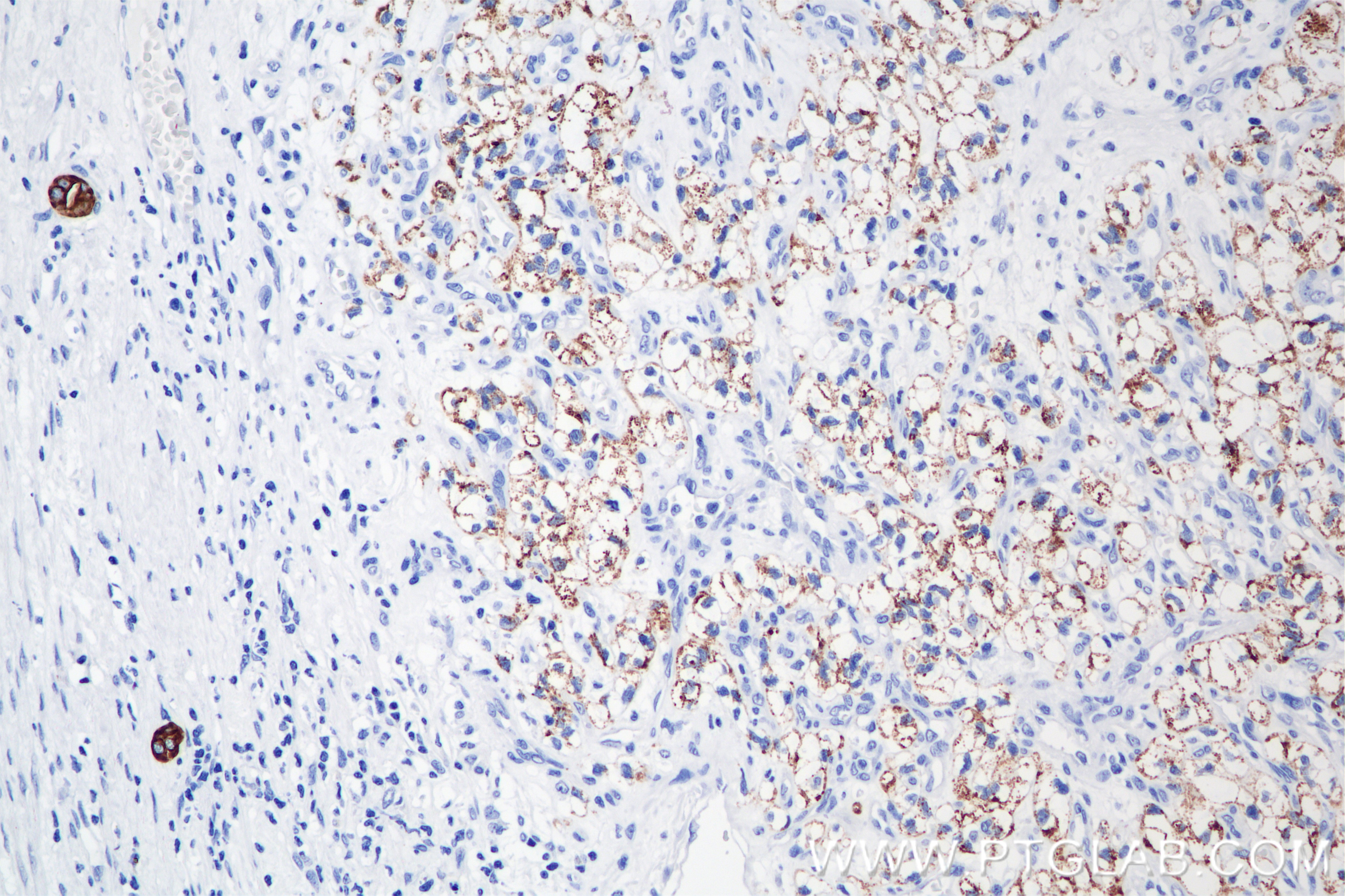 Immunohistochemical analysis of paraffin-embedded Human Kidney(renal cell) Cancer slide using 86457-4-RR (Cytokeratin 8 antibody) at dilution of 1:2000 (under 20x lens). Heat mediated antigen retrieval with Tris-EDTA buffer (pH 9.0). This data was developed using the same antibody clone with 86457-4-PBS in a different storage buffer formulation. Immunohistochemistry (IHC) staining of Human Kidney(renal cell) Cancer using Cytokeratin 8 Recombinant monoclonal antibody (86457-4-RR)