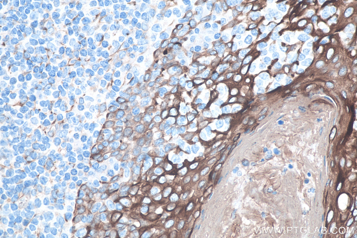 Immunohistochemistry (IHC) staining of human tonsillitis tissue using Cytokeratin 8-specific Polyclonal antibody (27105-1-AP)