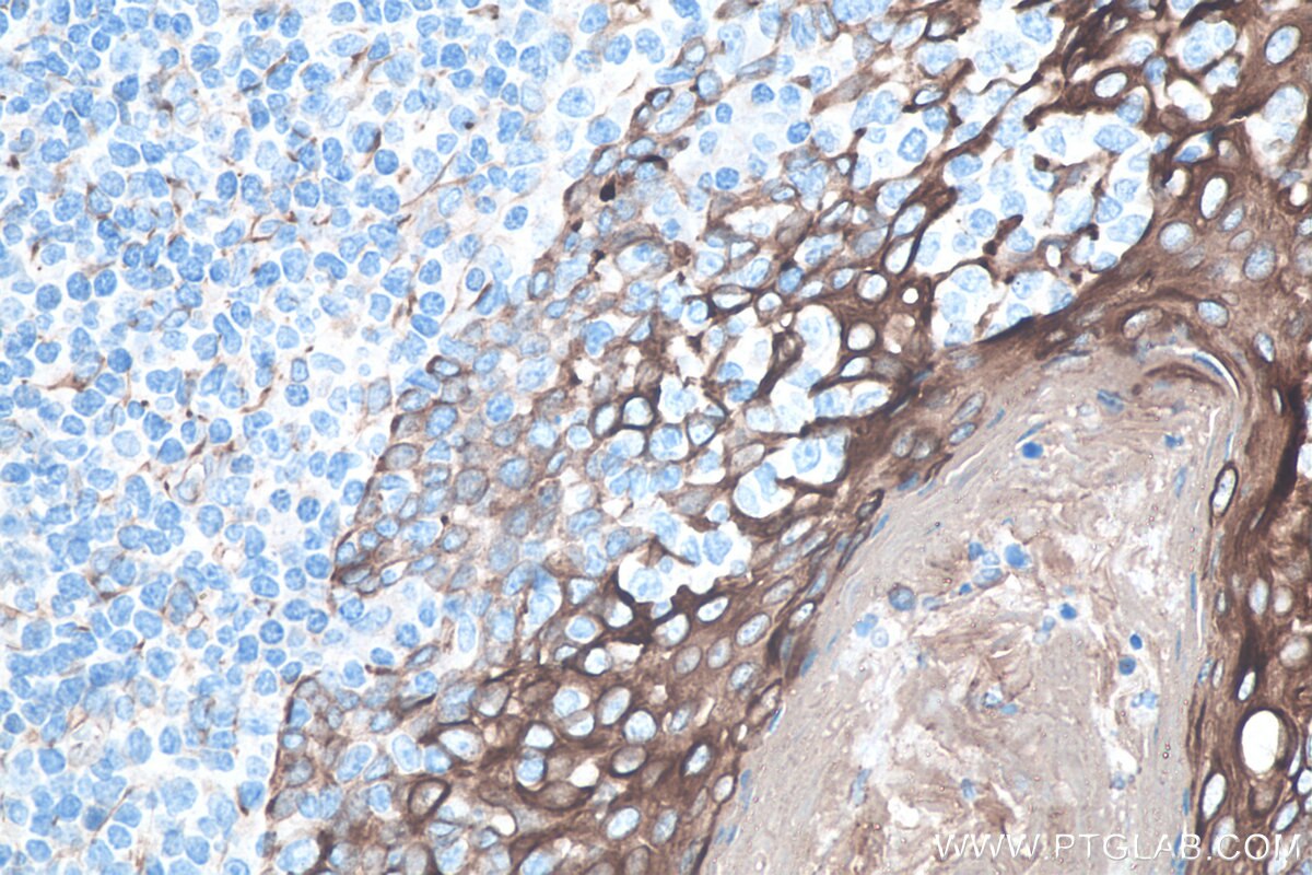 Immunohistochemistry (IHC) staining of human tonsillitis tissue using Cytokeratin 8-specific Polyclonal antibody (27105-1-AP)