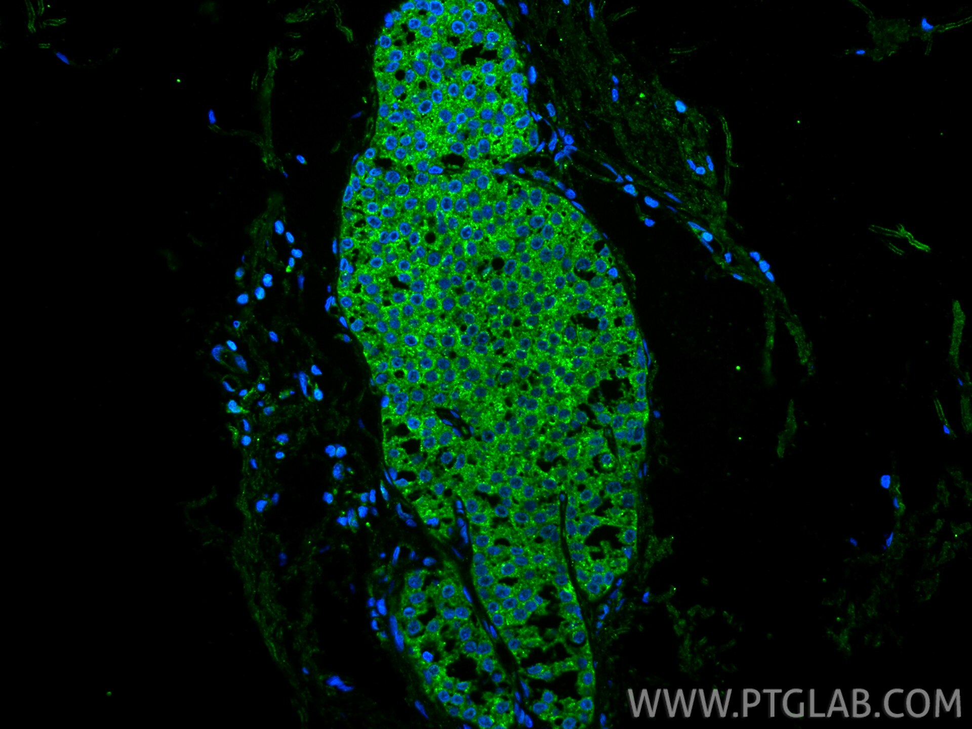 Immunofluorescence (IF) / fluorescent staining of human breast cancer tissue using Cytokeratin 80 Recombinant monoclonal antibody (86313-1-RR)